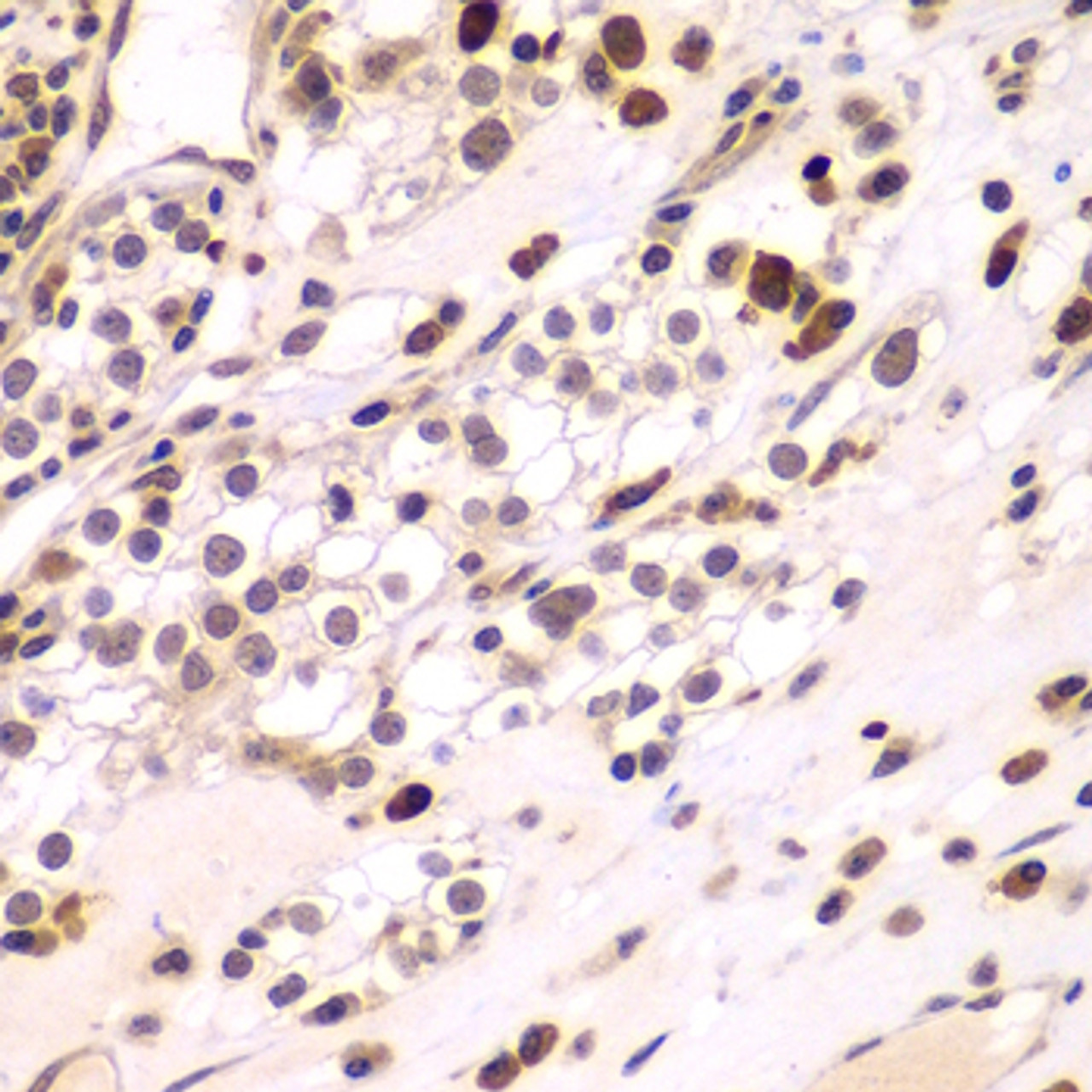 Immunohistochemistry of paraffin-embedded Human kidney cancer using CEBPG Polyclonal Antibody at dilution of  1:100 (40x lens).