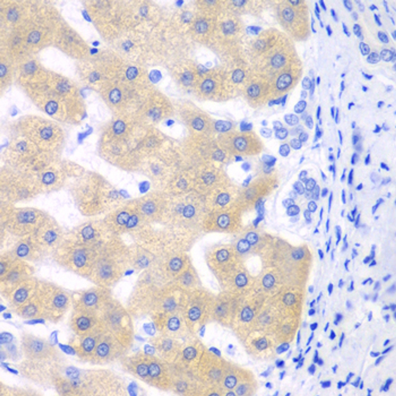 Immunohistochemistry of paraffin-embedded Human liver cancer using CYP2C18 Polyclonal Antibody at dilution of  1:100 (40x lens).
