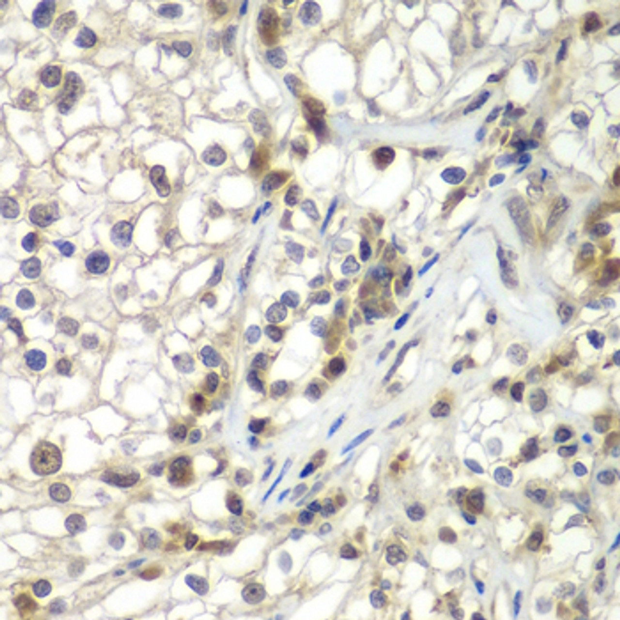 Immunohistochemistry of paraffin-embedded Human kidney cancer using ASPSCR1 Polyclonal Antibody at dilution of  1:100 (40x lens).