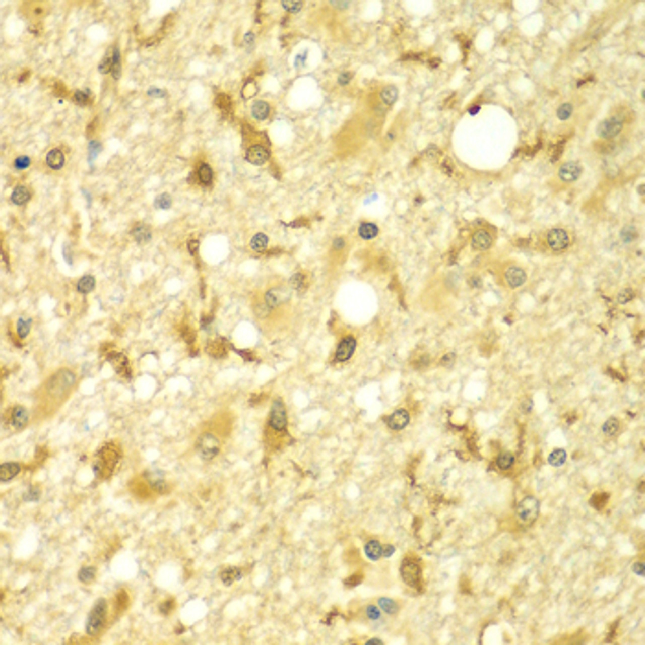 Immunohistochemistry of paraffin-embedded Human brain cancer using SPAG16 Polyclonal Antibody at dilution of  1:100 (40x lens).