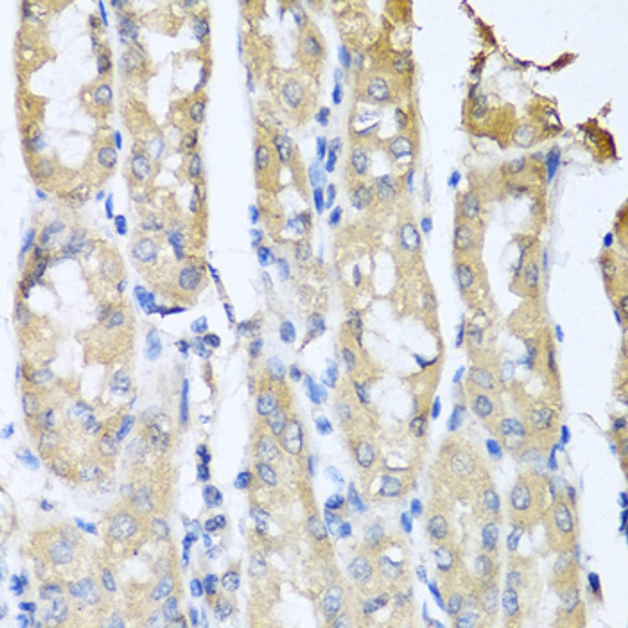 Immunohistochemistry of paraffin-embedded Human gastric cancer using CCL3 Polyclonal Antibody at dilution of  1:100 (40x lens).