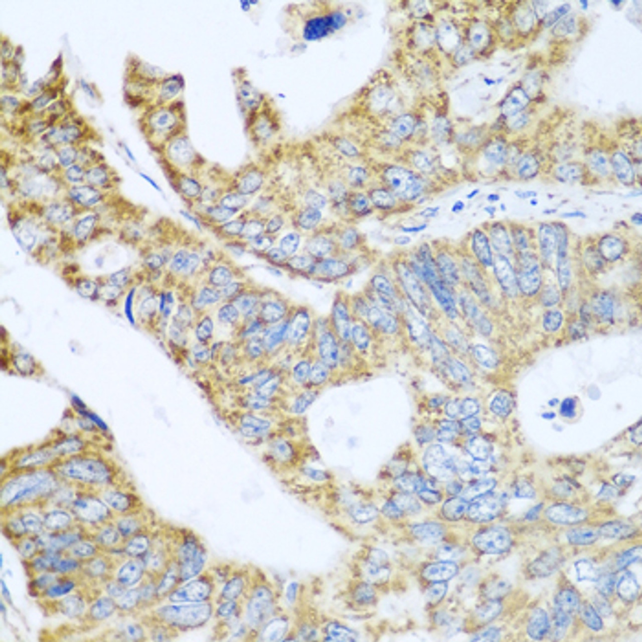 Immunohistochemistry of paraffin-embedded Human colon carcinoma using GLUD1 Polyclonal Antibody at dilution of  1:100 (40x lens).