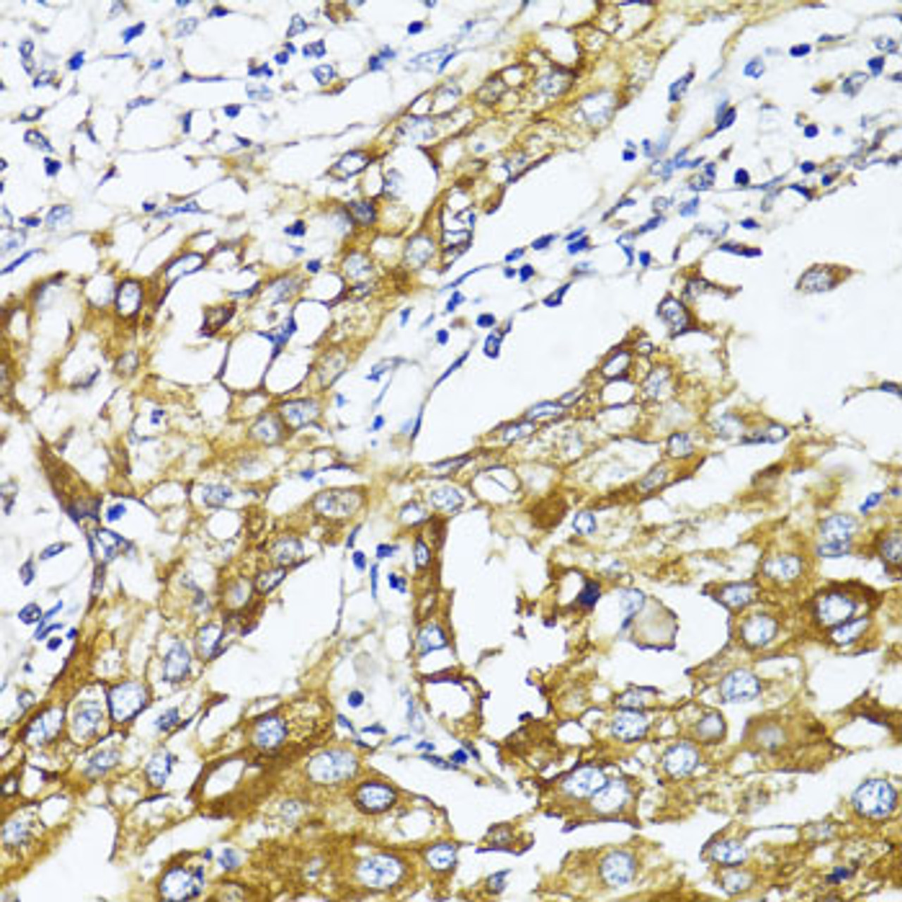 Immunohistochemistry of paraffin-embedded Human liver cancer using GLUT4 Polyclonal Antibody at dilution of  1:100 (40x lens).