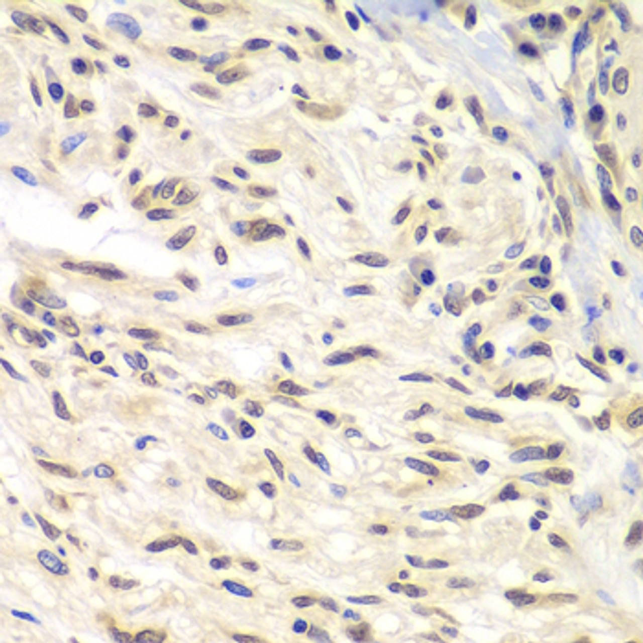 Immunohistochemistry of paraffin-embedded Human gastric cancer using CHEK1 Polyclonal Antibody at dilution of  1:100 (40x lens).