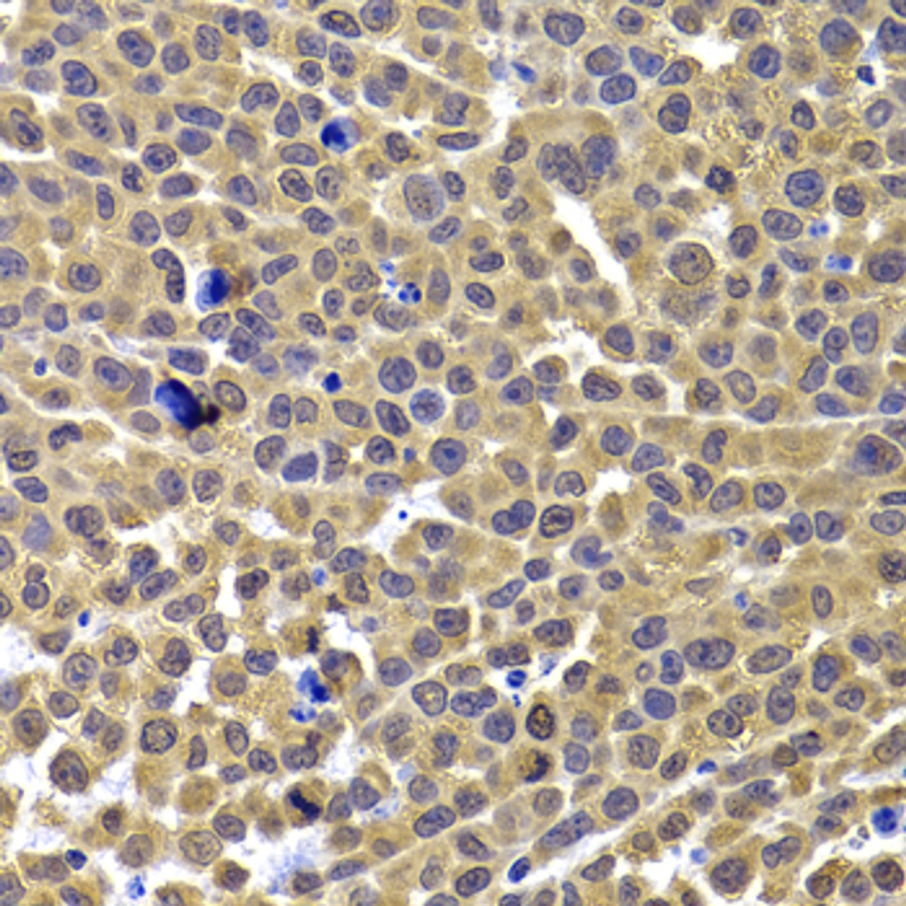 Immunohistochemistry of paraffin-embedded Mouse lung cancer using ARID3A Polyclonal Antibody at dilution of  1:100 (40x lens).