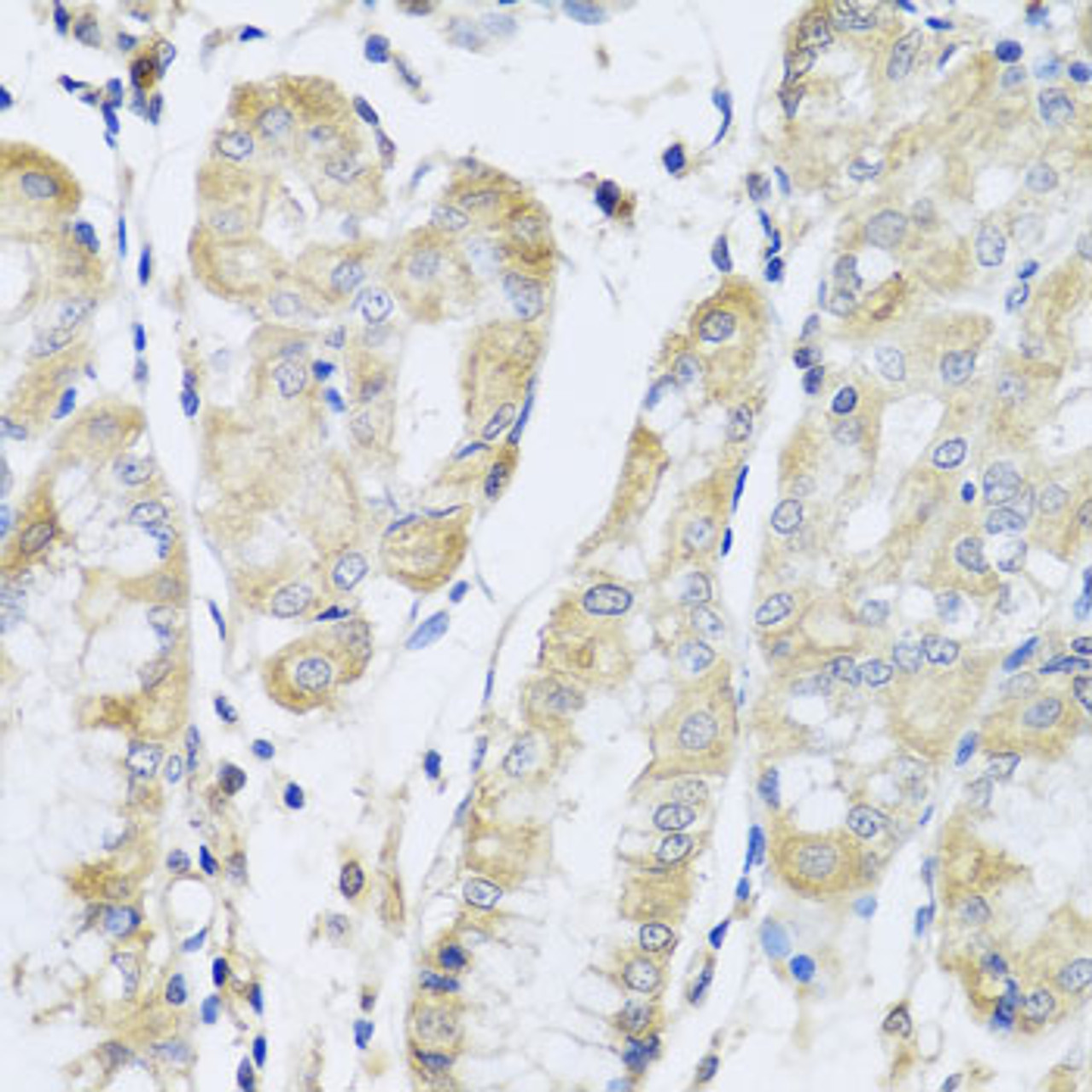 Immunohistochemistry of paraffin-embedded Human stomach using FANCA Polyclonal Antibody at dilution of  1:100 (40x lens).