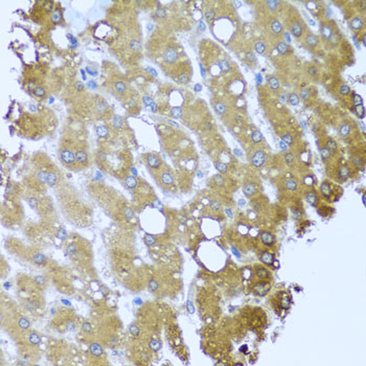 Immunohistochemistry of paraffin-embedded Human liver damage using STRN Polyclonal Antibody at dilution of  1:100 (40x lens).