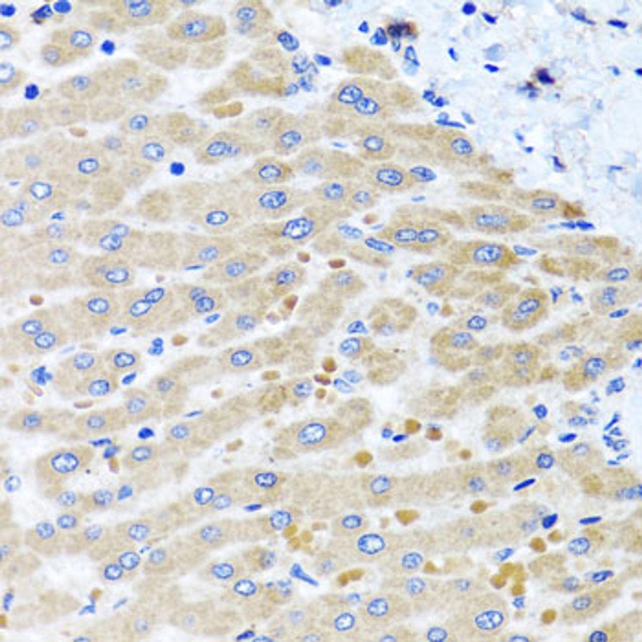 Immunohistochemistry of paraffin-embedded Human liver damage using DARS2 Polyclonal Antibody at dilution of  1:100 (40x lens).