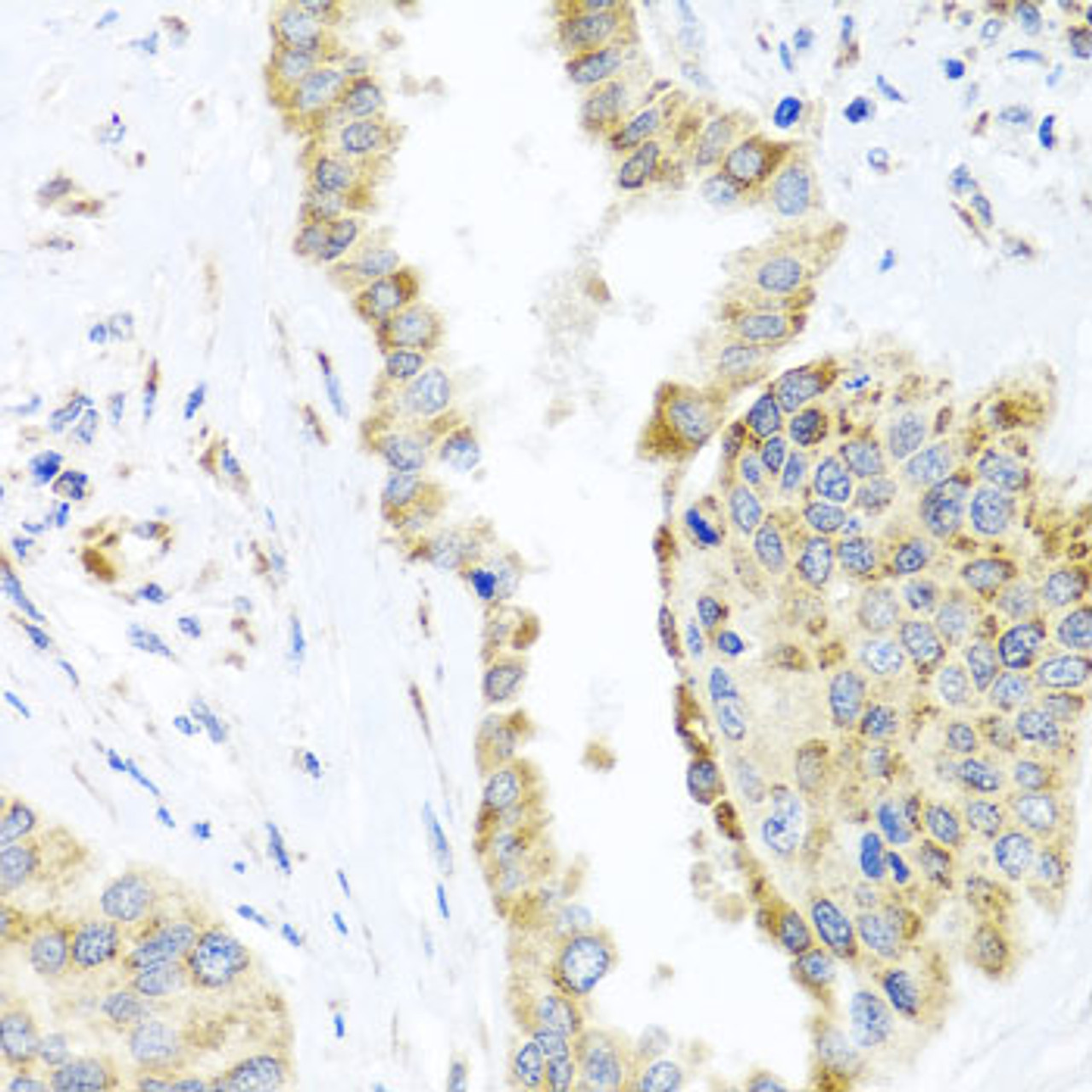Immunohistochemistry of paraffin-embedded Human lung cancer using DARS2 Polyclonal Antibody at dilution of  1:100 (40x lens).