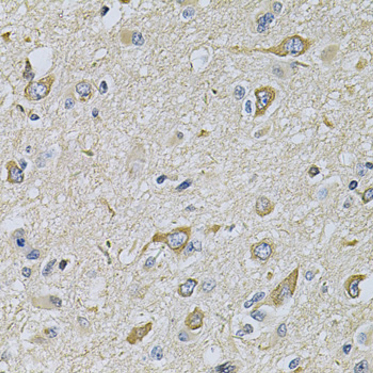 Immunohistochemistry of paraffin-embedded Human brain cancer using RAB17 Polyclonal Antibody at dilution of  1:100 (40x lens).