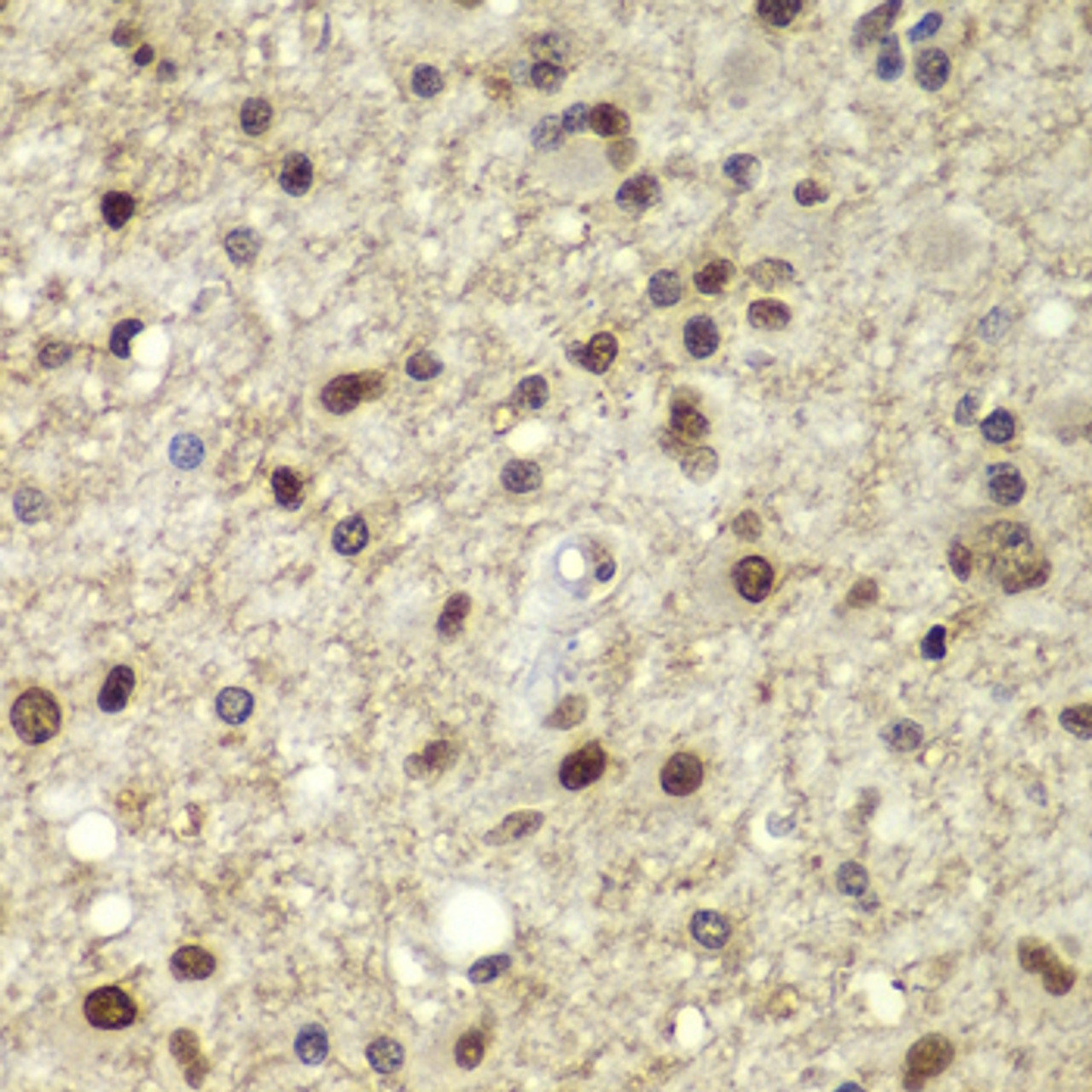 Immunohistochemistry of paraffin-embedded Human brain cancer using OCT4 Polyclonal Antibody at dilution of  1:100 (40x lens).