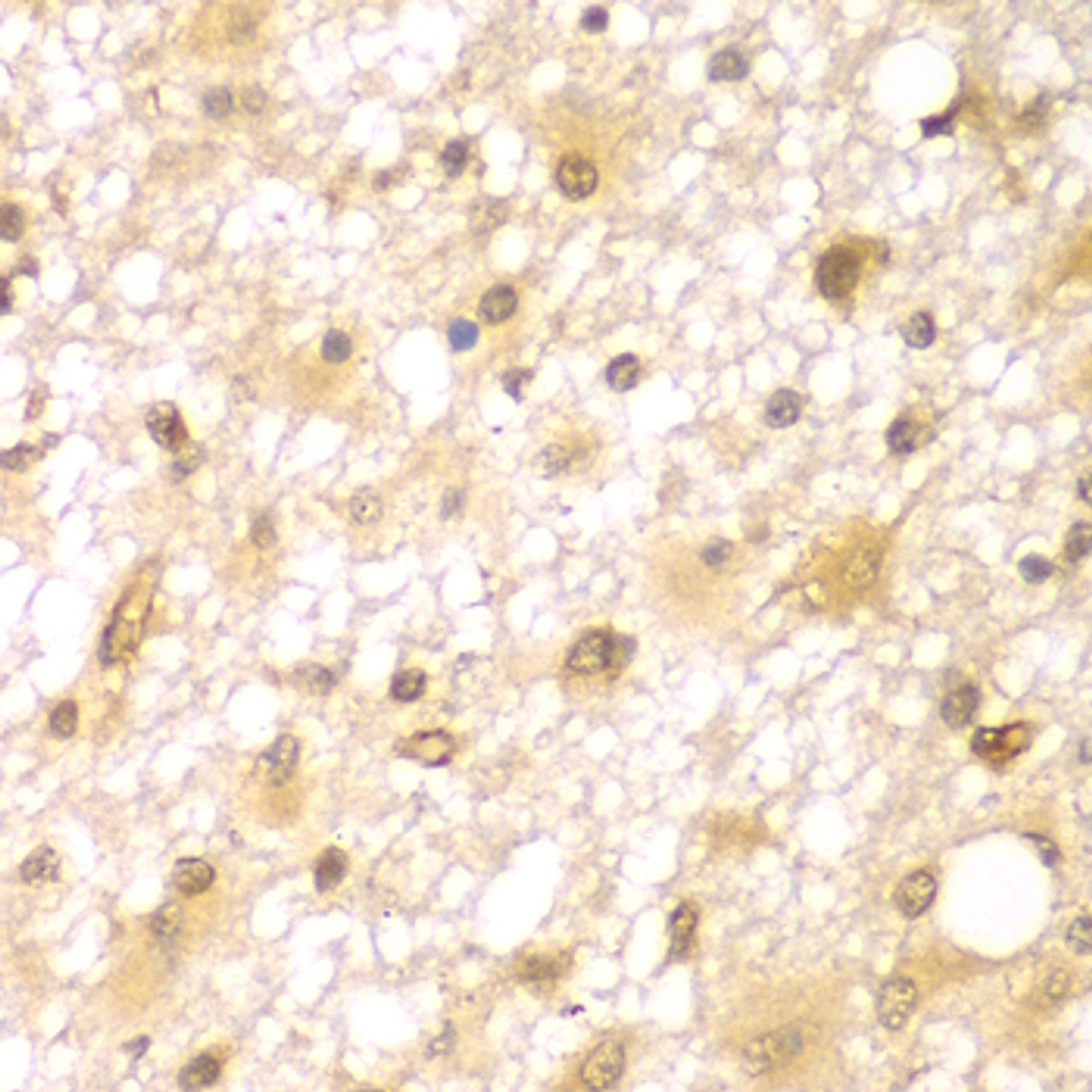 Immunohistochemistry of paraffin-embedded Human brain cancer using RUFY2 Polyclonal Antibody at dilution of  1:100 (40x lens).