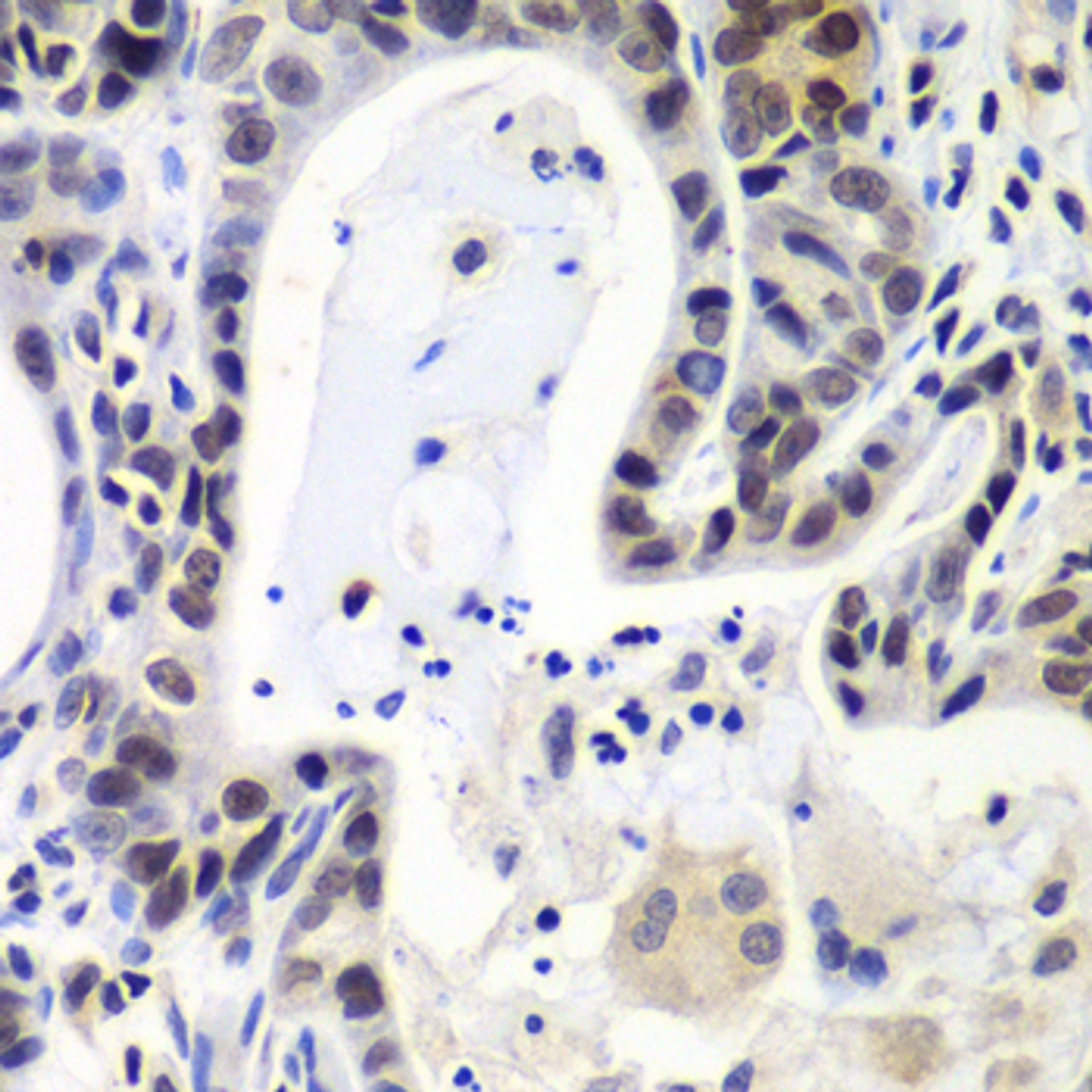 Immunohistochemistry of paraffin-embedded Human gastric cancer using LSM2 Polyclonal Antibody at dilution of  1:100 (40x lens).