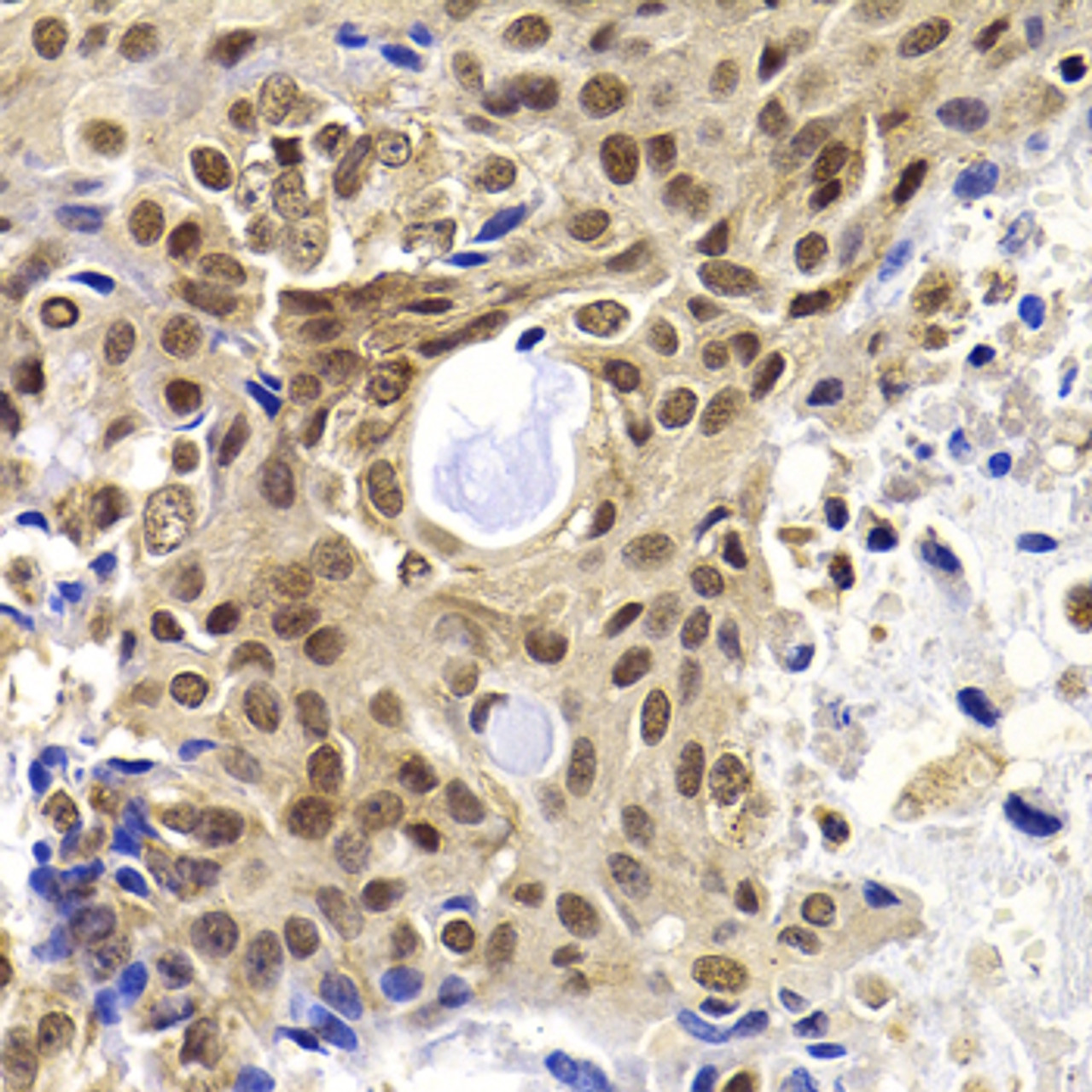 Immunohistochemistry of paraffin-embedded Human oophoroma using PHF19 Polyclonal Antibody at dilution of  1:100 (40x lens).