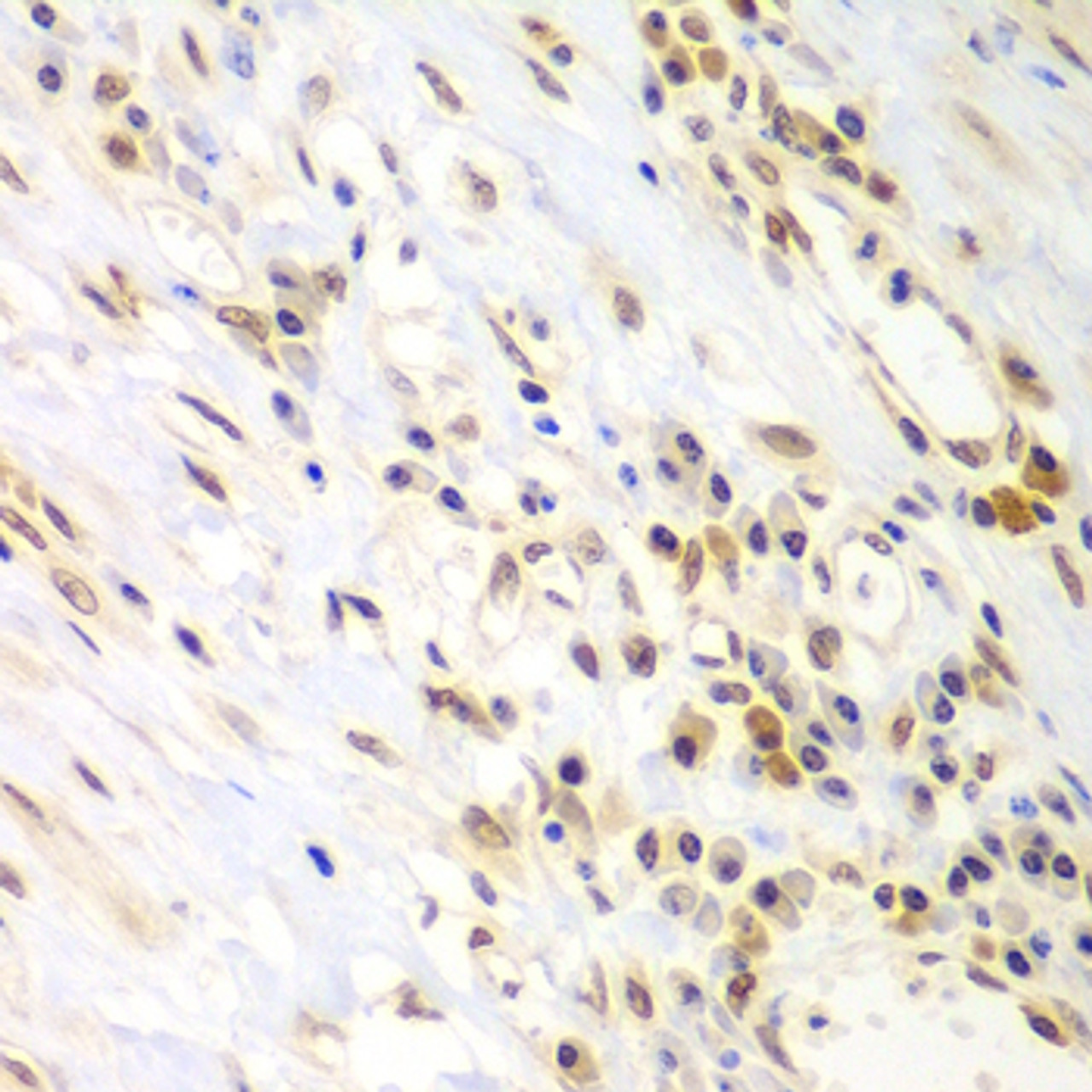 Immunohistochemistry of paraffin-embedded Human gastric cancer using LHX4 Polyclonal Antibody at dilution of  1:100 (40x lens).