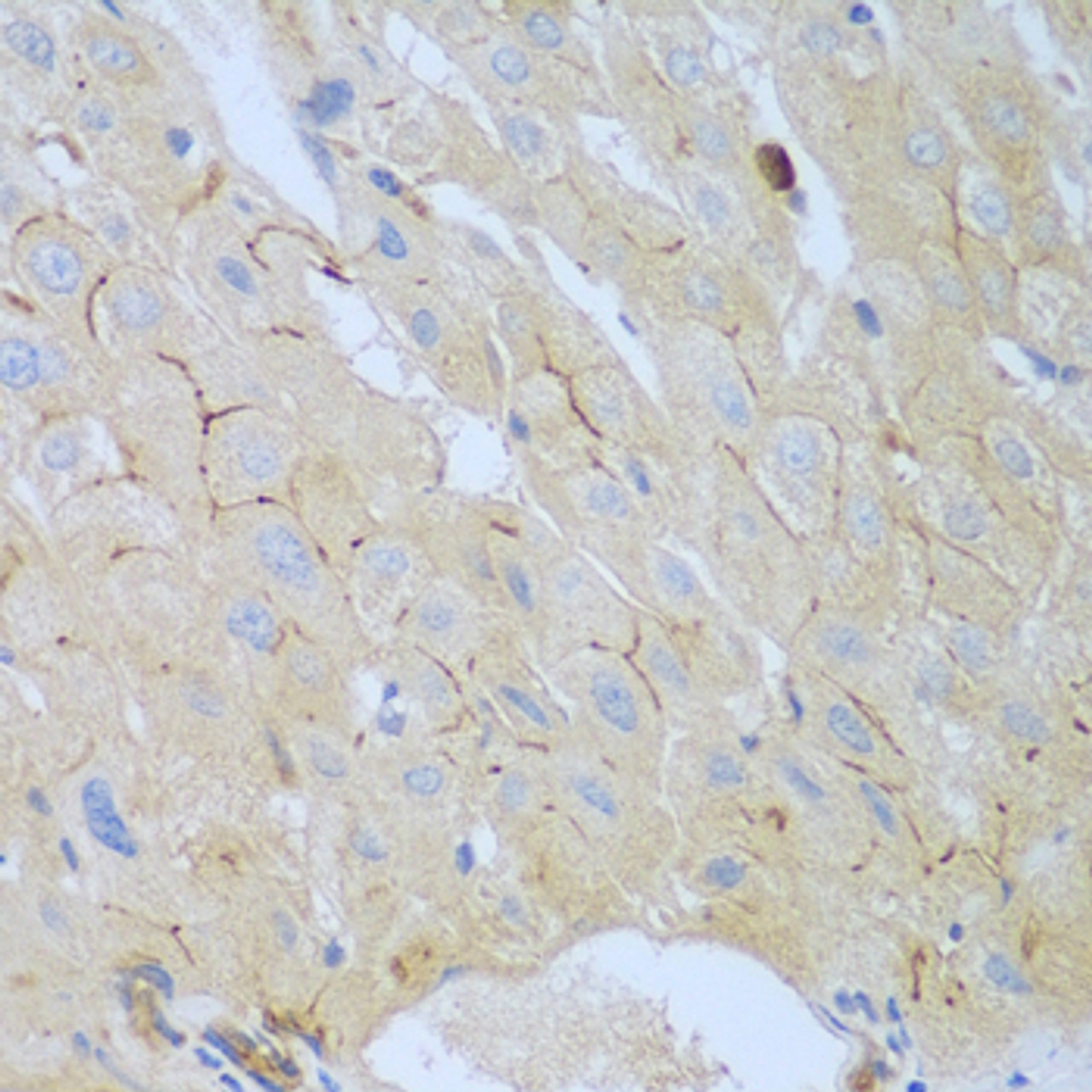 Immunohistochemistry of paraffin-embedded Human liver cancer using CEACAM7 Polyclonal Antibody at dilution of  1:100 (40x lens).