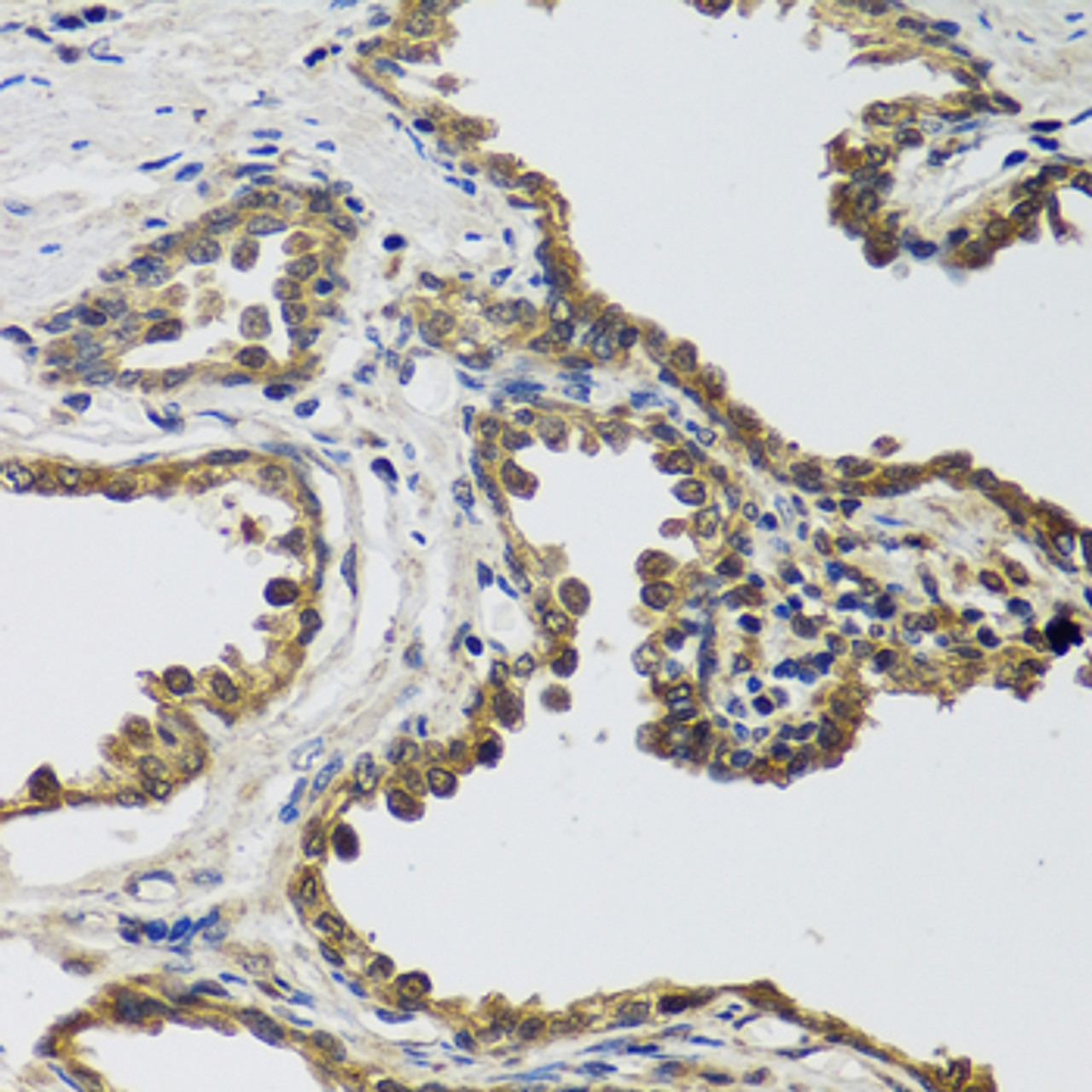 Immunohistochemistry of paraffin-embedded Human prostate using IL25 Polyclonal Antibody at dilution of  1:100 (40x lens).