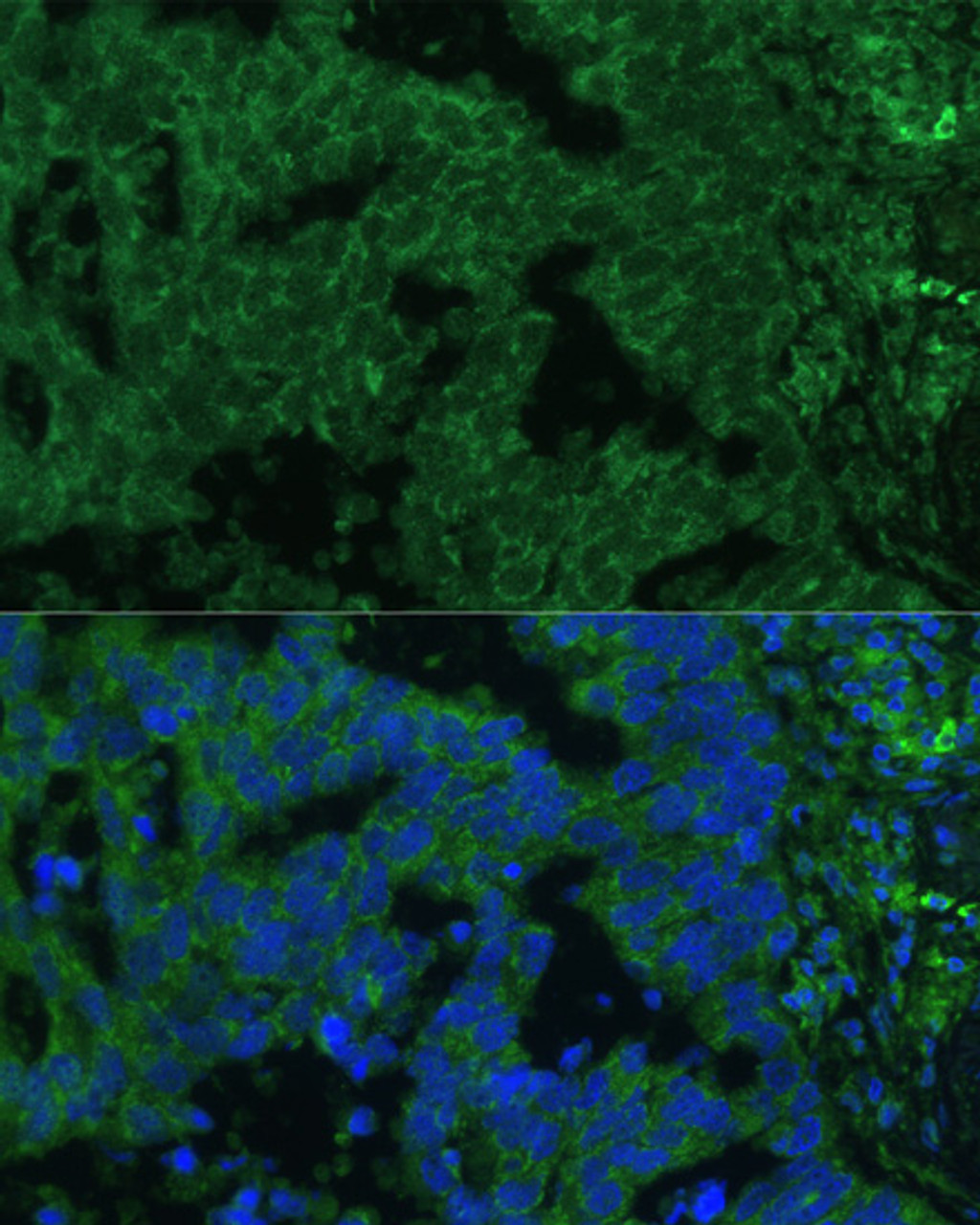 Immunofluorescence analysis of Human lung cancer cells using IL25 Polyclonal Antibody at dilution of  1:100. Blue: DAPI for nuclear staining.