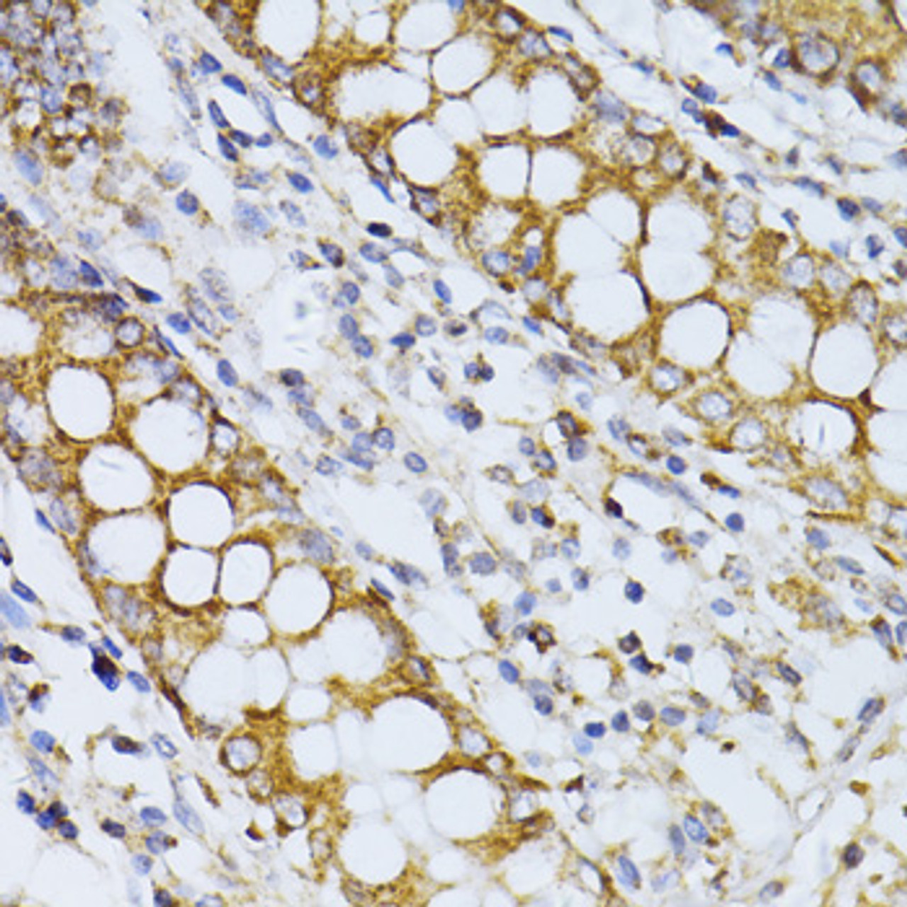 Immunohistochemistry of paraffin-embedded Human colon using CCDC92 Polyclonal Antibody at dilution of  1:100 (40x lens).