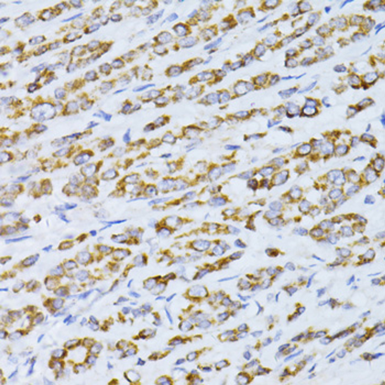 Immunohistochemistry of paraffin-embedded Human colon carcinoma using CCDC92 Polyclonal Antibody at dilution of  1:100 (40x lens).