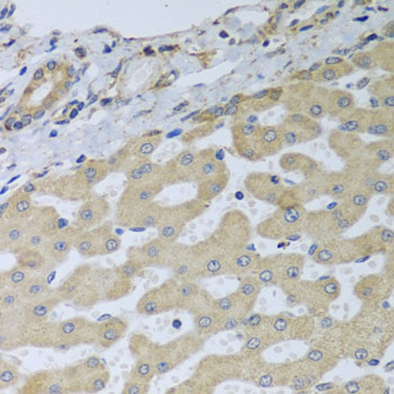 Immunohistochemistry of paraffin-embedded Human liver damage using ATAD3B Polyclonal Antibody at dilution of  1:100 (40x lens).