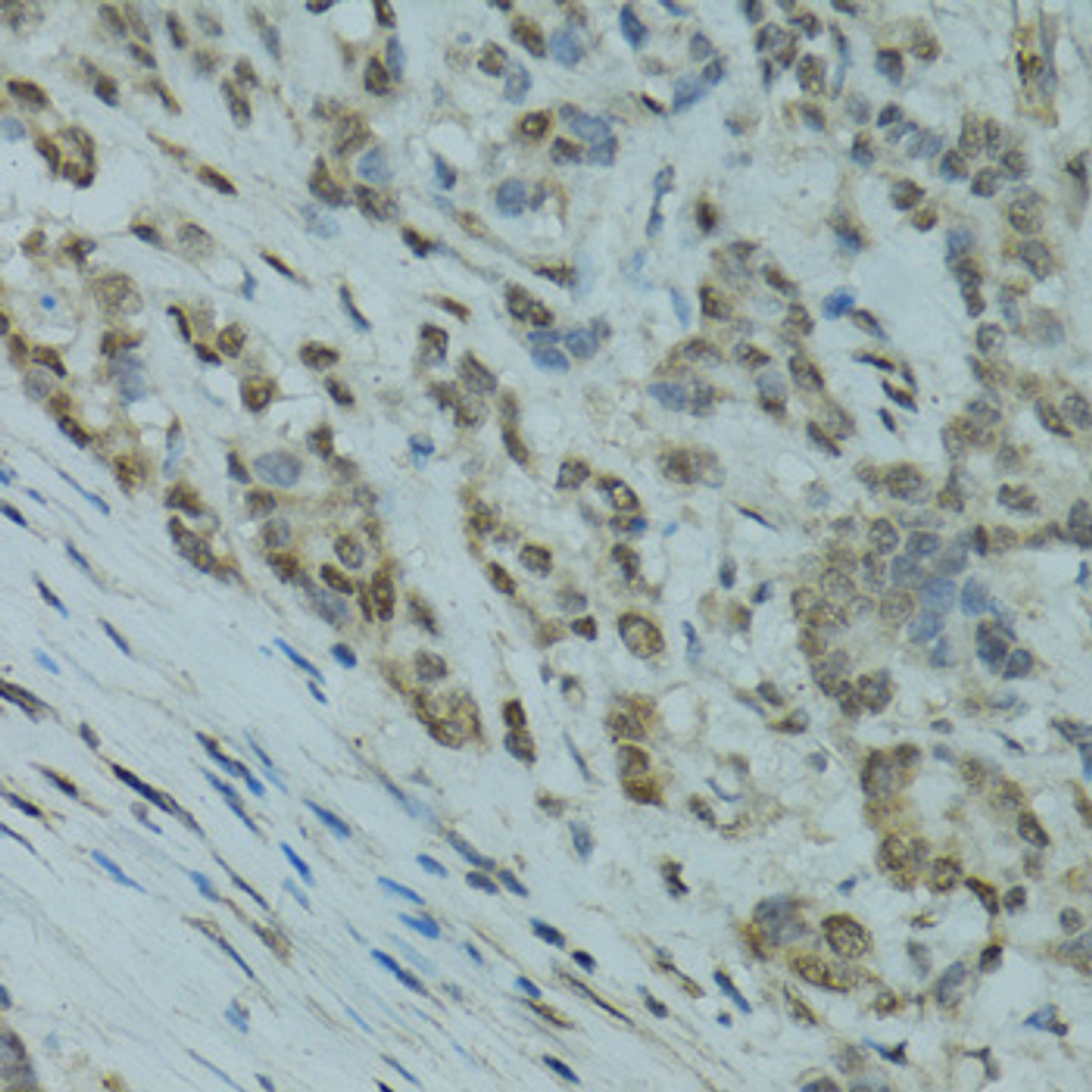 Immunohistochemistry of paraffin-embedded Human colon carcinoma using GABPA Polyclonal Antibody at dilution of  1:100 (40x lens).