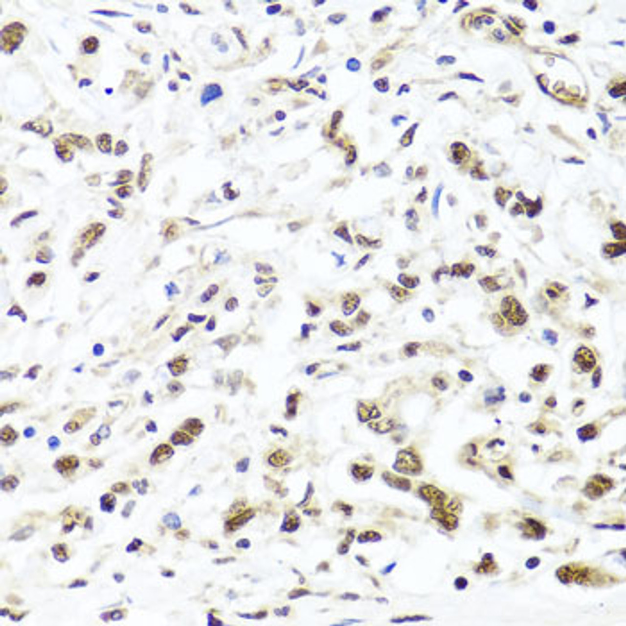 Immunohistochemistry of paraffin-embedded Human gastric cancer using HIRA Polyclonal Antibody at dilution of  1:100 (40x lens).