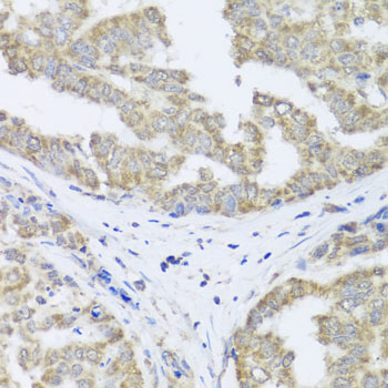 Immunohistochemistry of paraffin-embedded Human liver cancer using TIMM10B Polyclonal Antibody at dilution of  1:100 (40x lens).