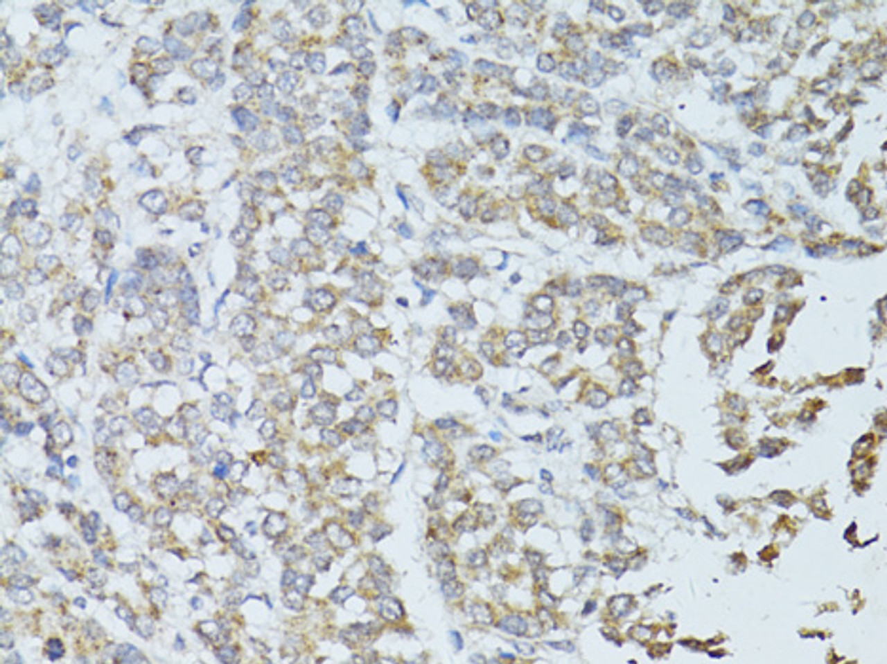 Immunohistochemistry of paraffin-embedded Human colon carcinoma using TEFM Polyclonal Antibody at dilution of  1:100 (40x lens).