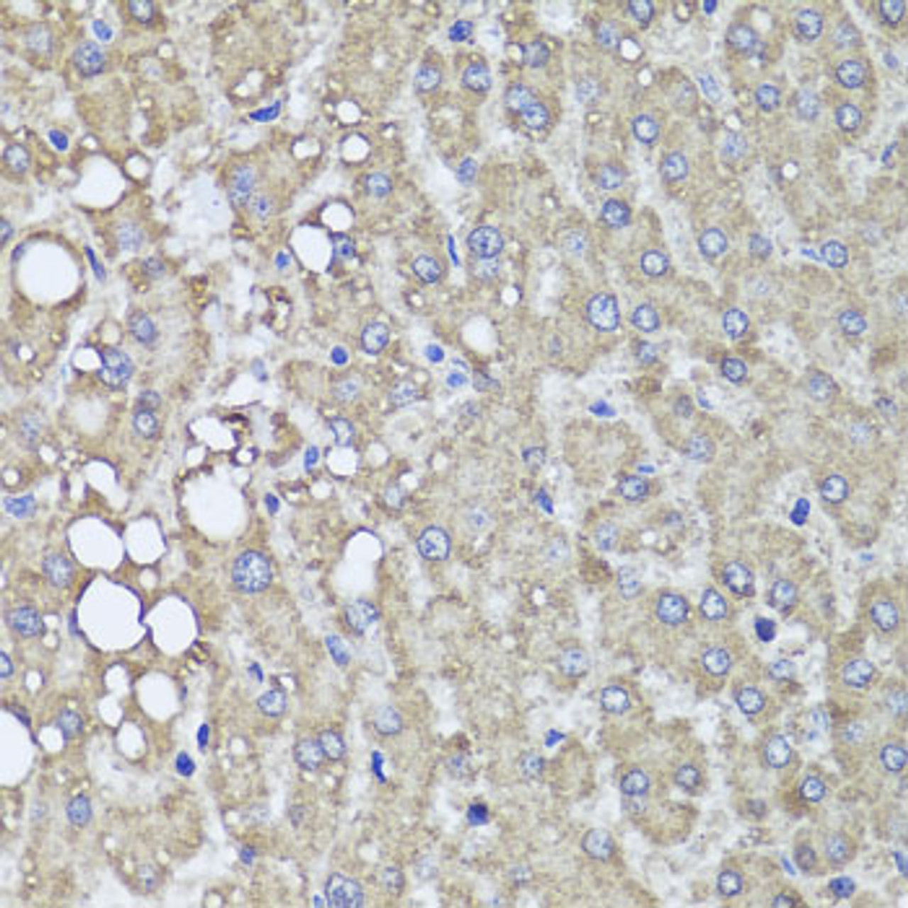 Immunohistochemistry of paraffin-embedded Human liver damage using PIK3C2A Polyclonal Antibody at dilution of  1:100 (40x lens).