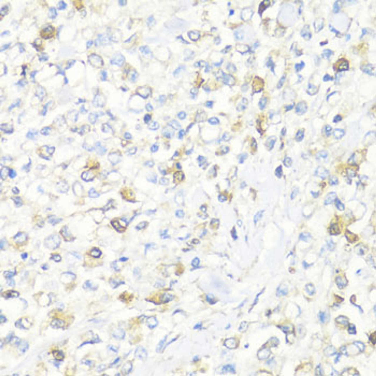 Immunohistochemistry of paraffin-embedded Human gastric cancer using EIF3J Polyclonal Antibody at dilution of  1:100 (40x lens).