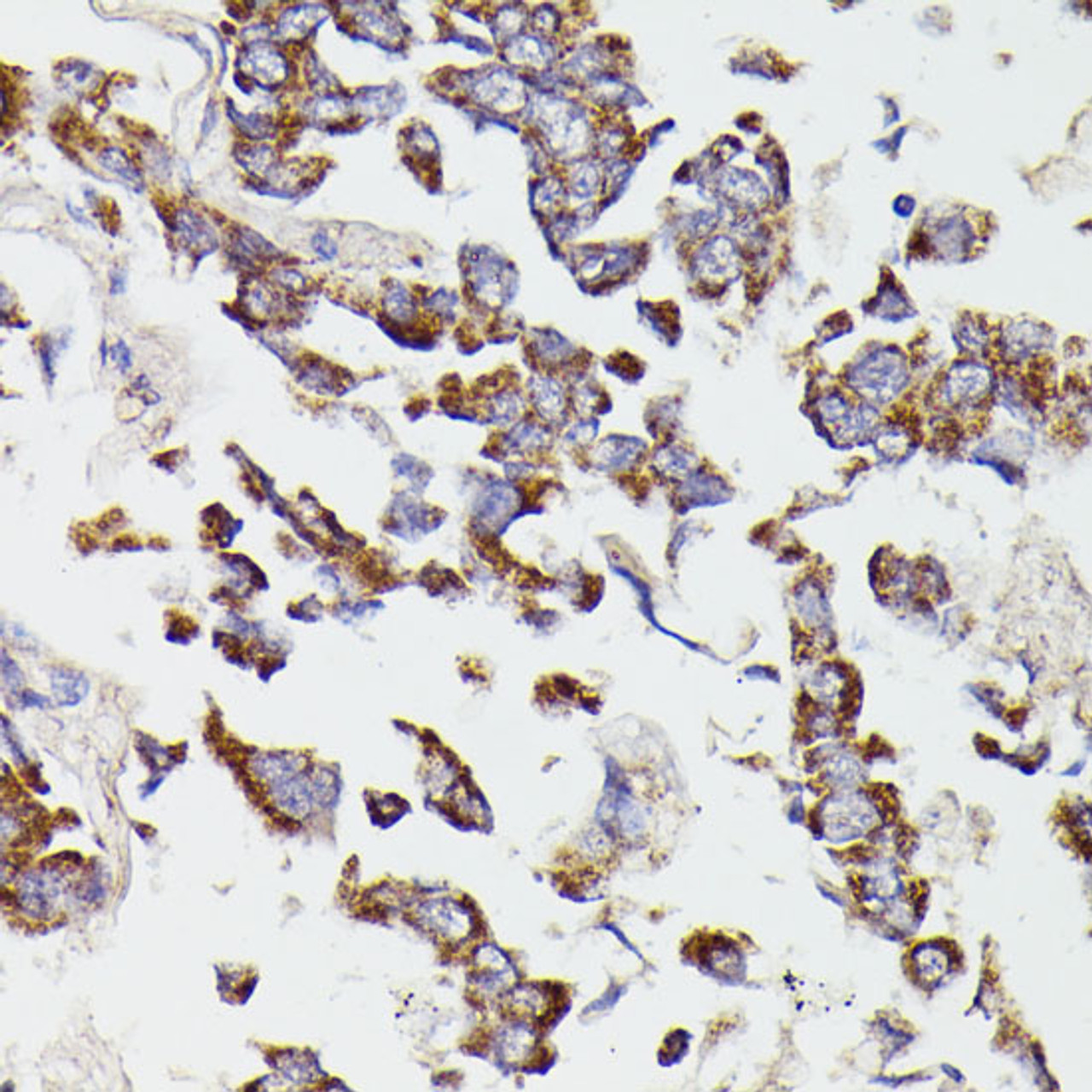 Immunohistochemistry of paraffin-embedded Human lung cancer using SUCLG2 Polyclonal Antibody at dilution of  1:100 (40x lens).