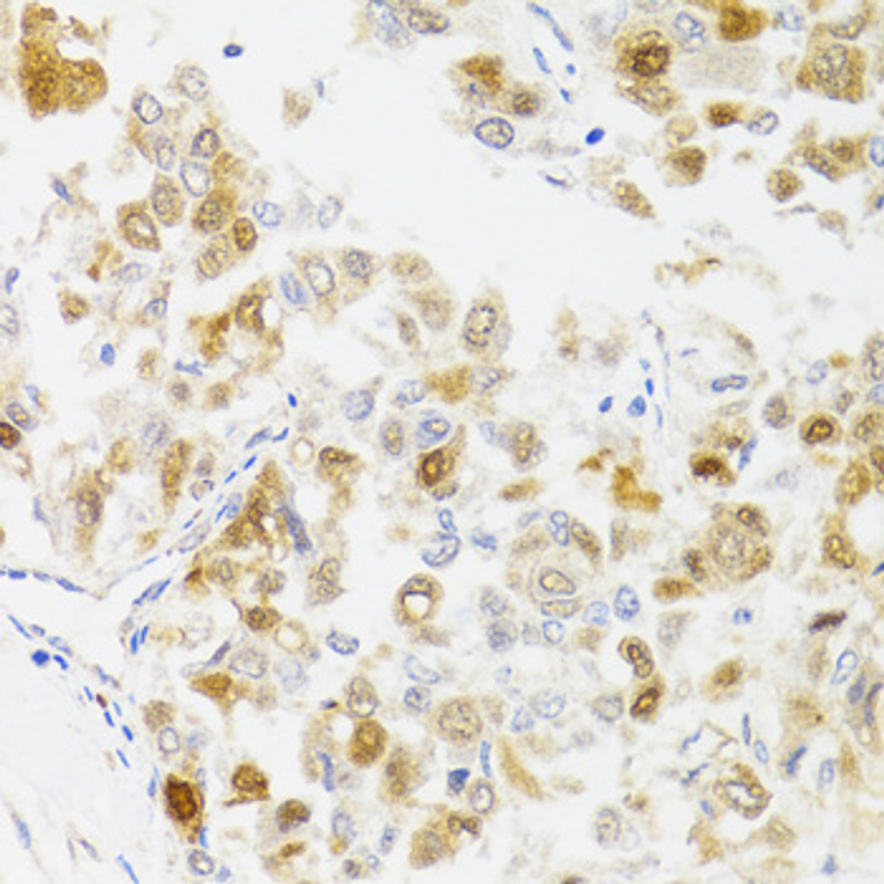 Immunohistochemistry of paraffin-embedded Human liver cancer using MYO5A Polyclonal Antibody at dilution of  1:100 (40x lens).