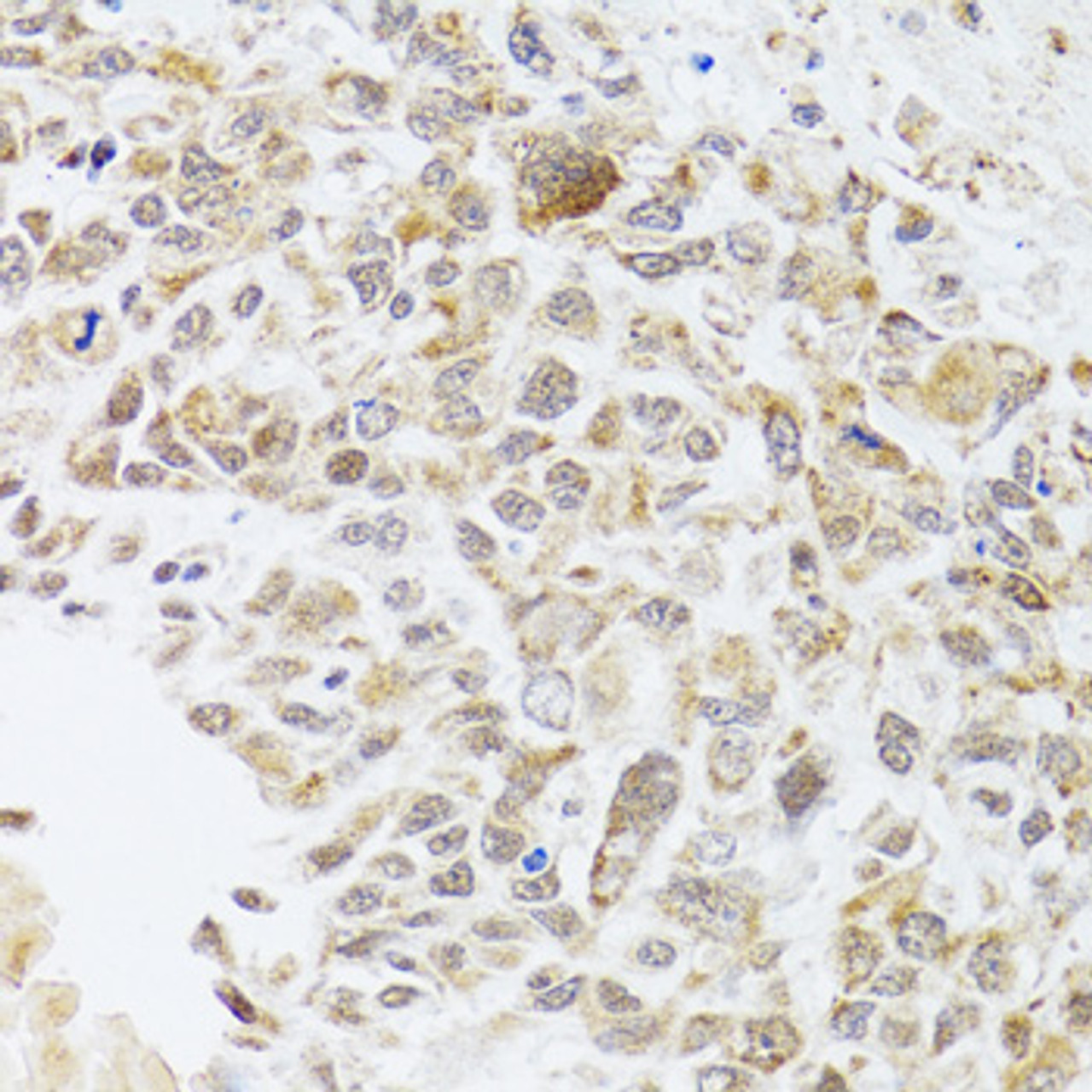 Immunohistochemistry of paraffin-embedded Human lung cancer using RNASEL Polyclonal Antibody at dilution of  1:100 (40x lens).