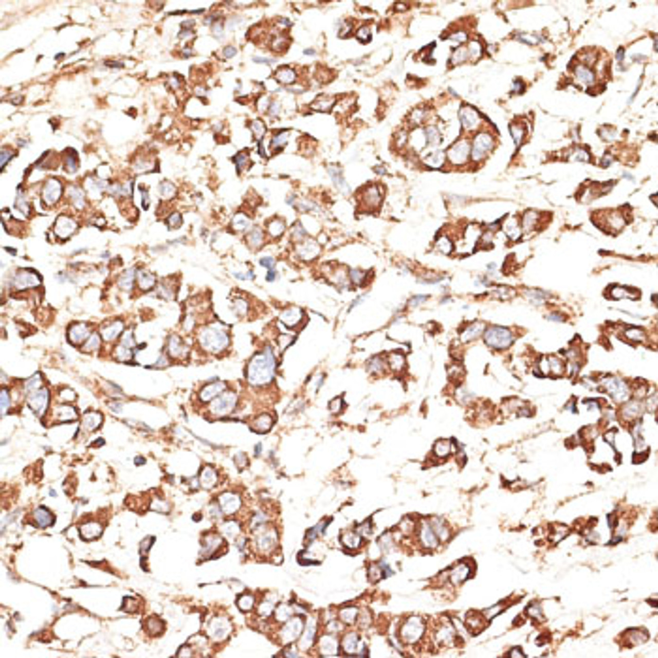 Immunohistochemistry of paraffin-embedded Human mammary cancer using KIR3DS1 Polyclonal Antibody at dilution of  1:100 (40x lens).