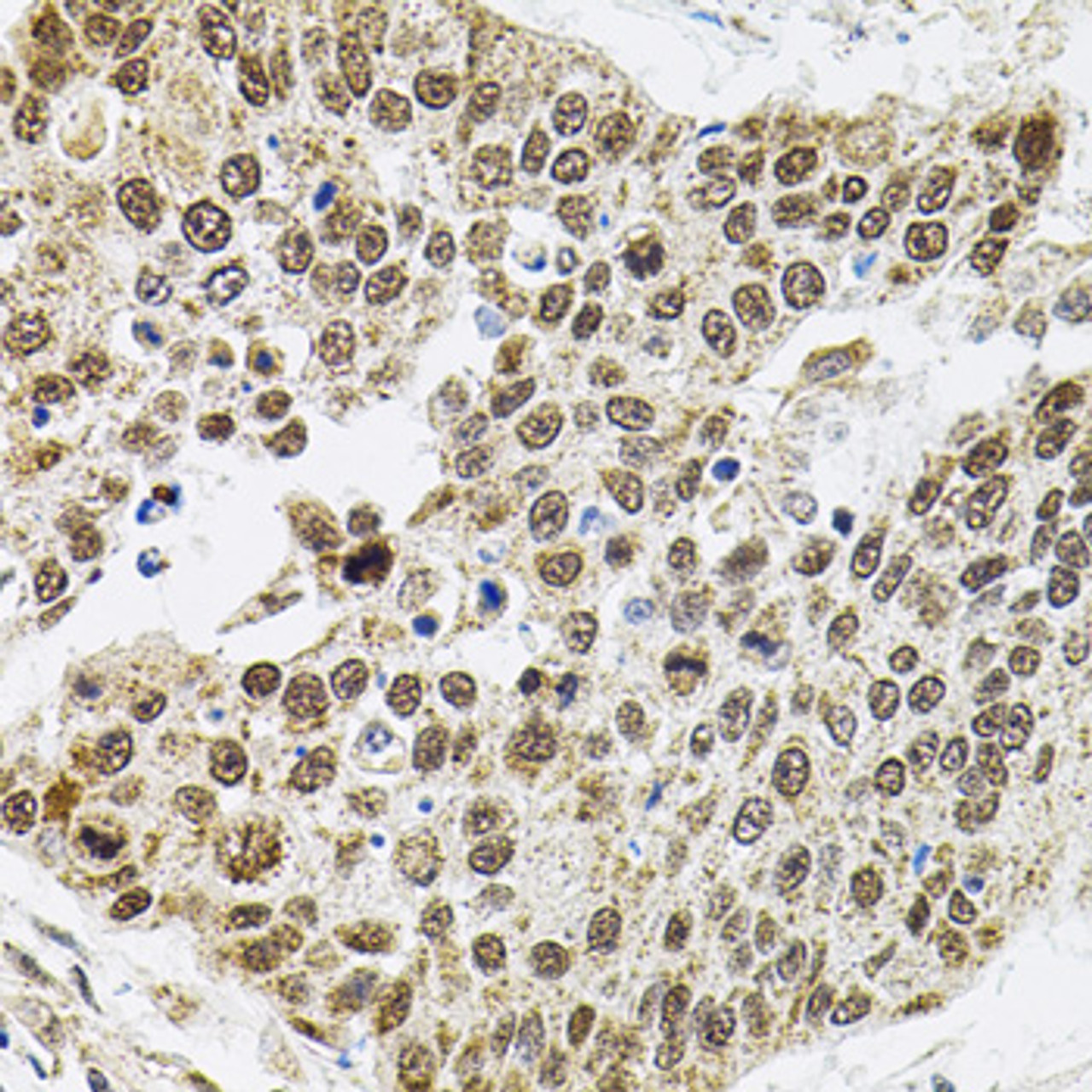 Immunohistochemistry of paraffin-embedded Human lung cancer using BAF60a Polyclonal Antibody at dilution of  1:100 (40x lens).