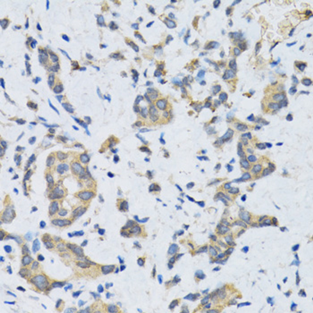 Immunohistochemistry of paraffin-embedded Human gastric cancer using SLC2A13 Polyclonal Antibody at dilution of  1:100 (40x lens).