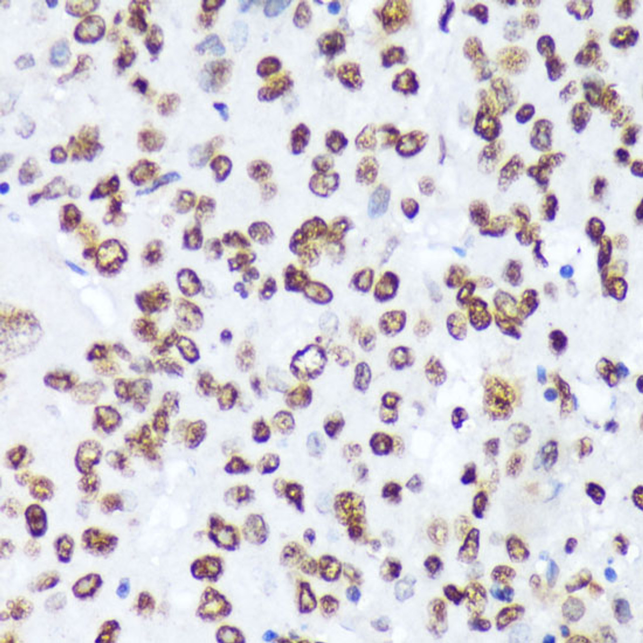 Immunohistochemistry of paraffin-embedded Human liver cancer using Phospho-ABL1(Y245) Polyclonal Antibody at dilution of  1:100 (40x lens).