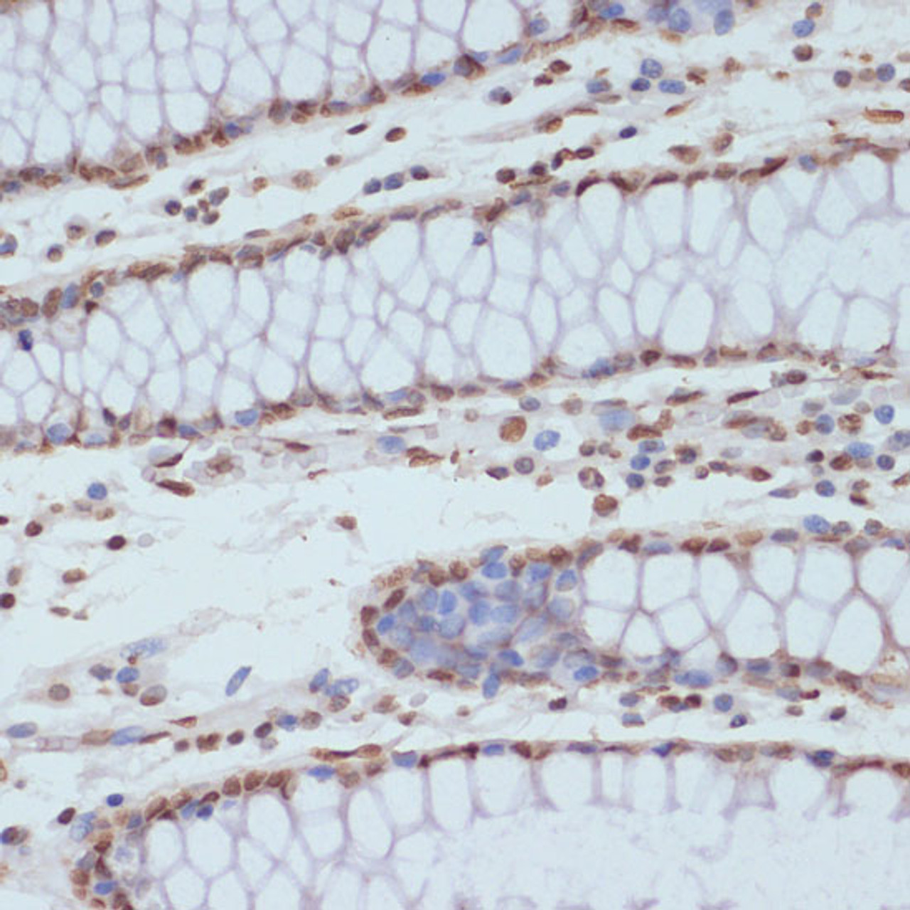 Immunohistochemistry of paraffin-embedded Human colon using Phospho-CDK1(Y15) Polyclonal Antibody at dilution of  1:100 (40x lens).