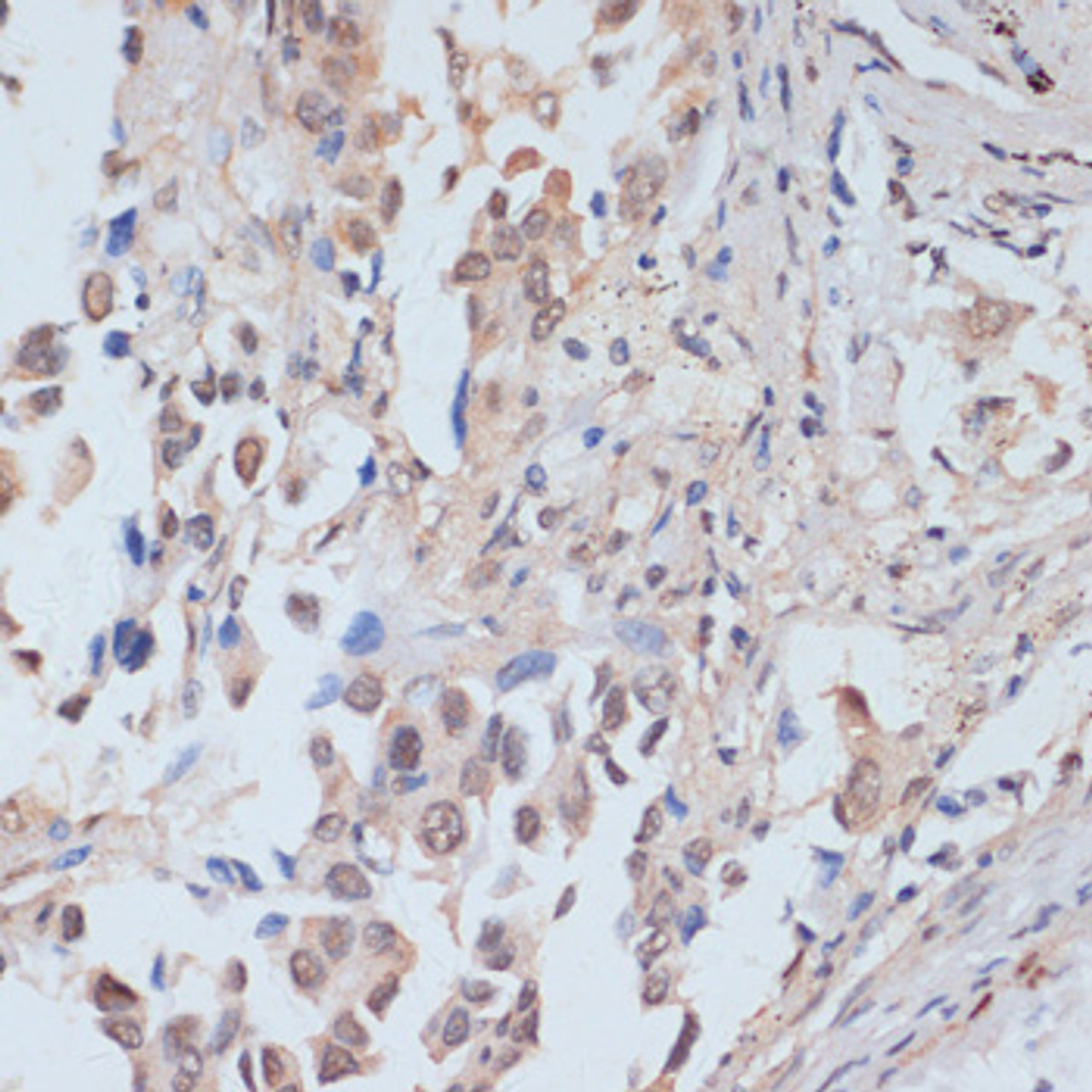 Immunohistochemistry of paraffin-embedded Human lung cancer using Phospho-STAT1(S727) Polyclonal Antibody at dilution of  1:100 (40x lens).