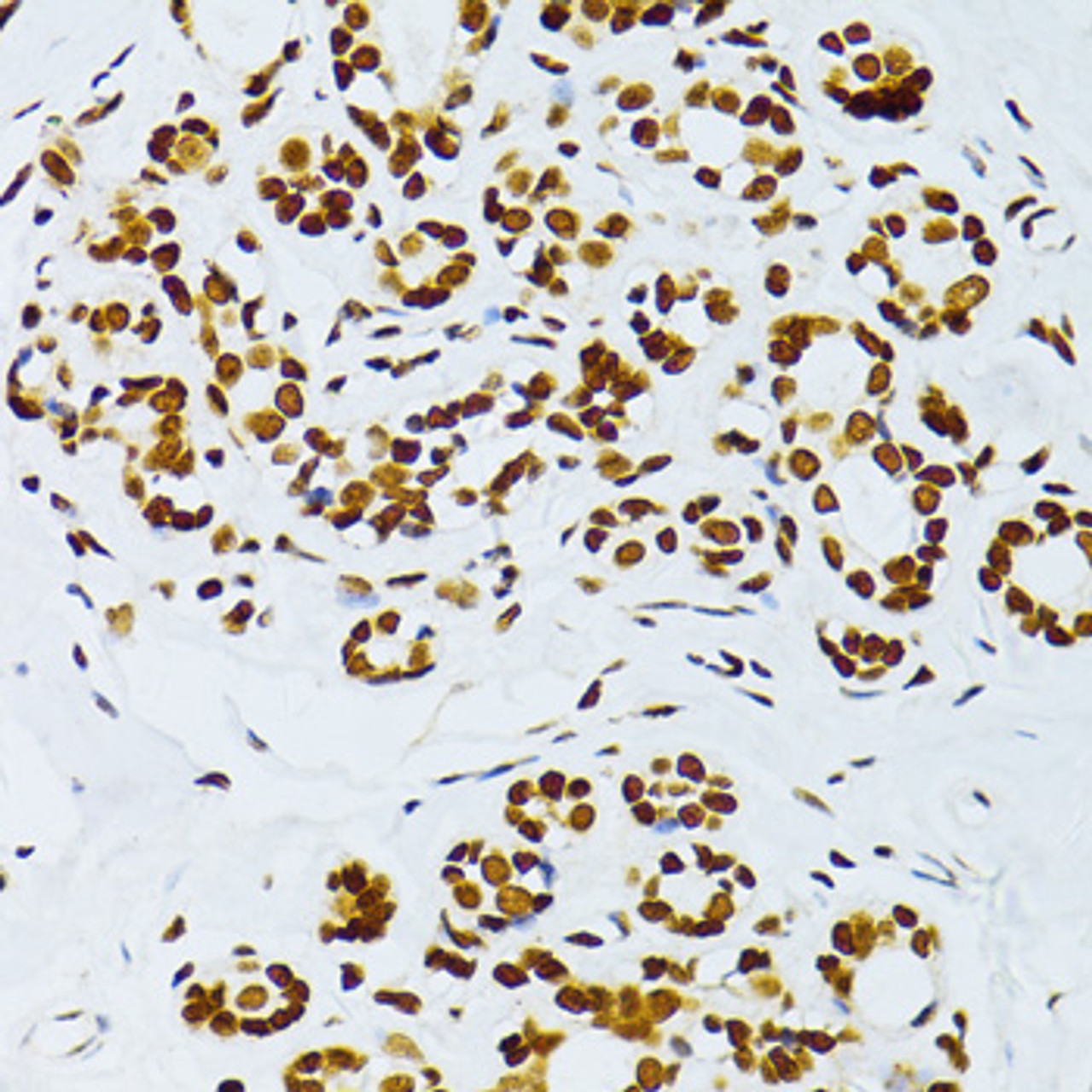 Immunohistochemistry of paraffin-embedded Human breast using Phospho-NF-kB p65(S276) Polyclonal Antibody at dilution of  1:100 (40x lens).