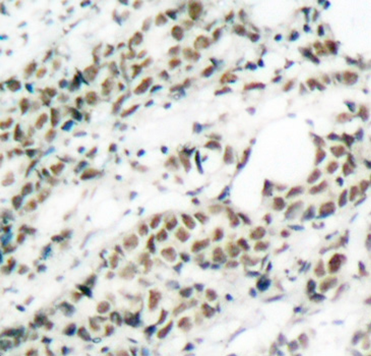 Immunohistochemistry of paraffin-embedded Human breast carcinoma tissue, using Phospho-FOXO4(S197) Polyclonal Antibody