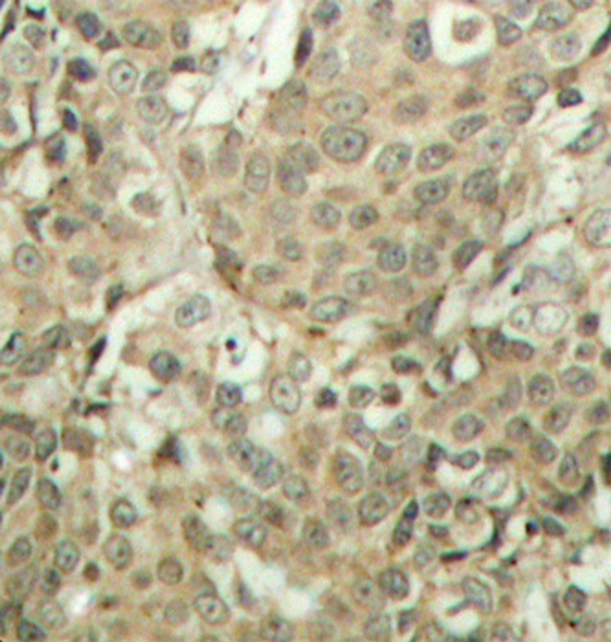 Immunohistochemistry of paraffin-embedded Human breast carcinoma tissue, using Phospho-CFL1(S3) Polyclonal Antibody