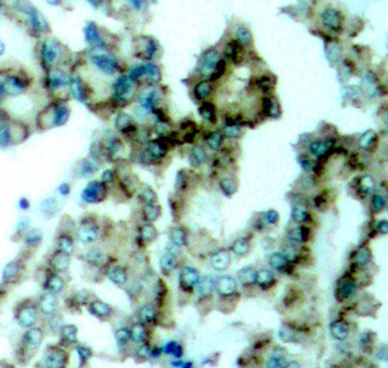 Immunohistochemistry of paraffin-embedded Human lung carcinoma tissue, using Phospho-PKCalpha/beta II(T638/641) Polyclonal Antibody