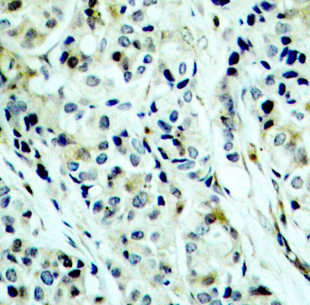 Immunohistochemistry of paraffin-embedded Human breast carcinoma using Phospho-HDAC5(S498) Polyclonal Antibody