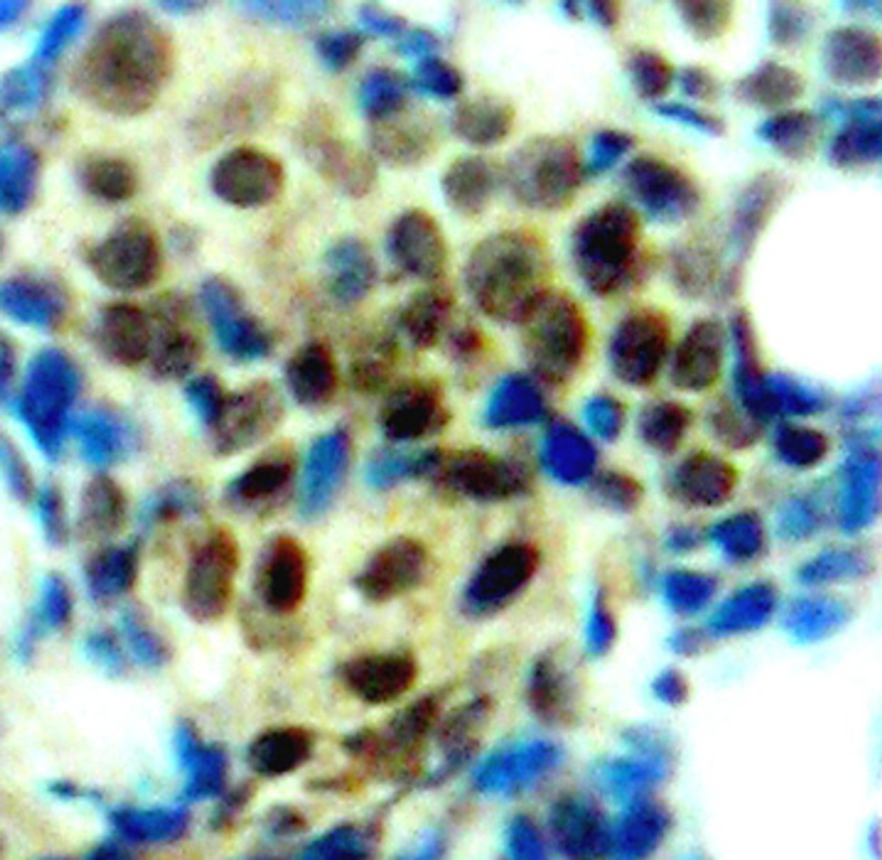 Immunohistochemistry of paraffin-embedded Human breast carcinoma tissue, using Phospho-MAPK3(T202) Polyclonal Antibody