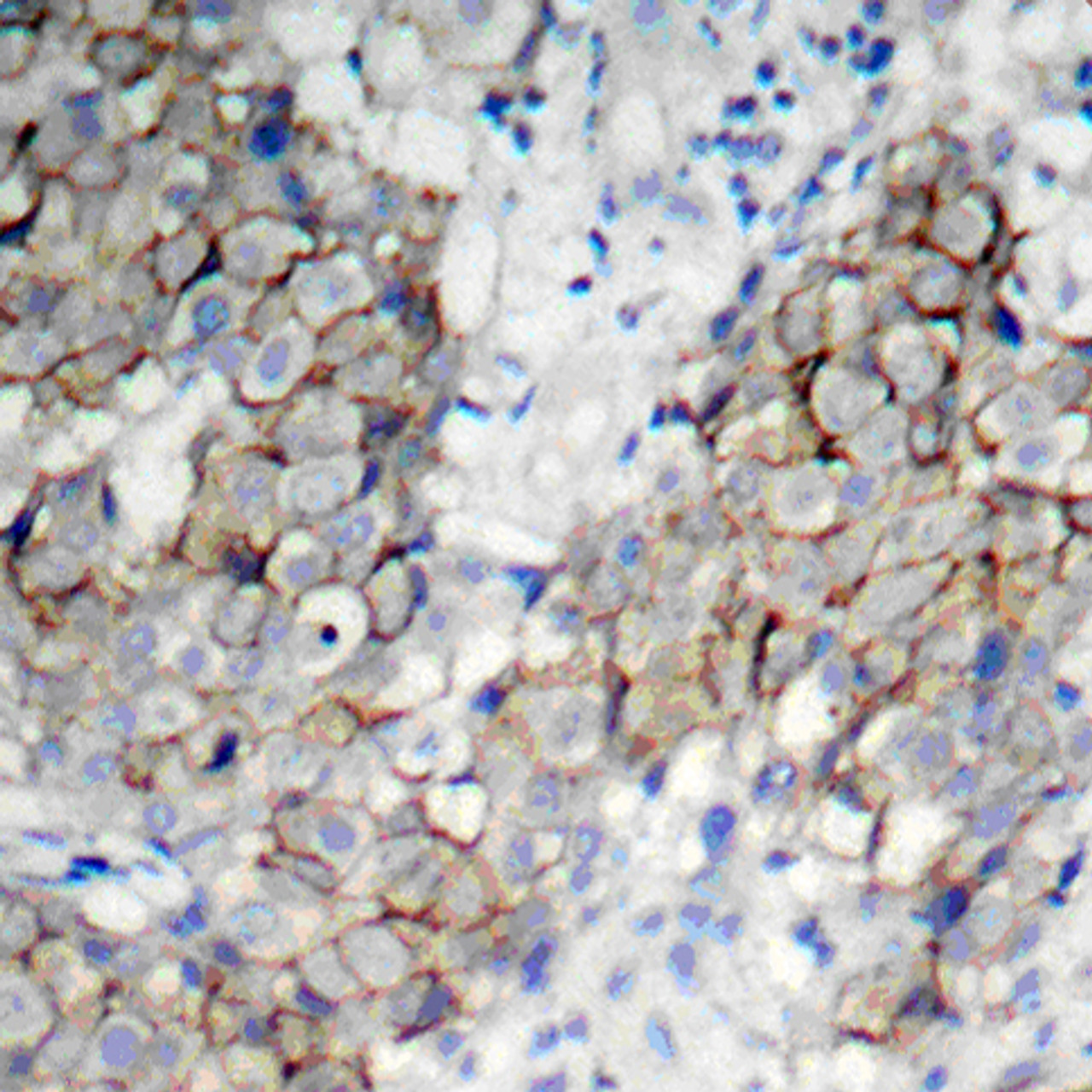 Immunohistochemistry of paraffin-embedded Human breast carcinoma using Phospho-IGF1R(Y1161) Polyclonal Antibody