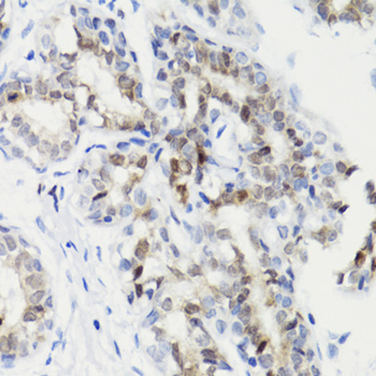 Immunohistochemistry of paraffin-embedded Human breast cancer using Phospho-Stat3(S727) Polyclonal Antibody at dilution of  1:100 (40x lens).
