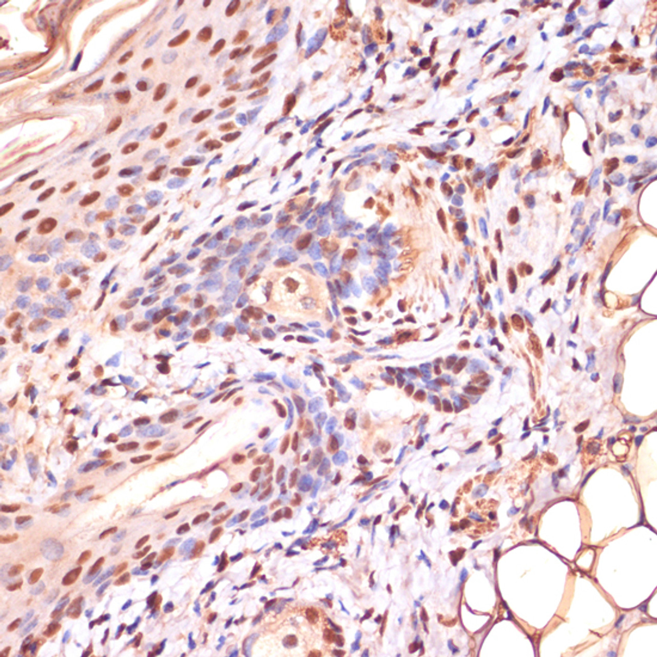 Immunohistochemistry of paraffin-embedded Human skin using Phospho-β-catenin(S33/S37/T41) Polyclonal Antibody at dilution of  1:100 (40x lens).