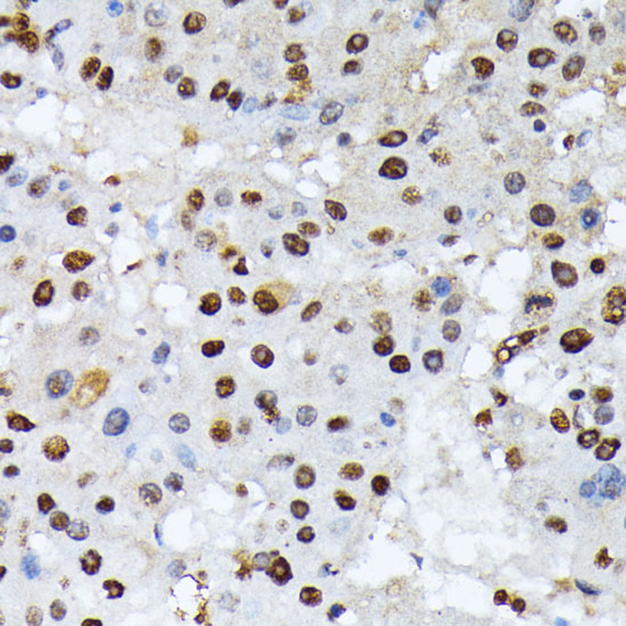 Immunohistochemistry of paraffin-embedded Human liver cancer using Phospho-ATF2(T69/T71) Polyclonal Antibody at dilution of  1:100 (40x lens).